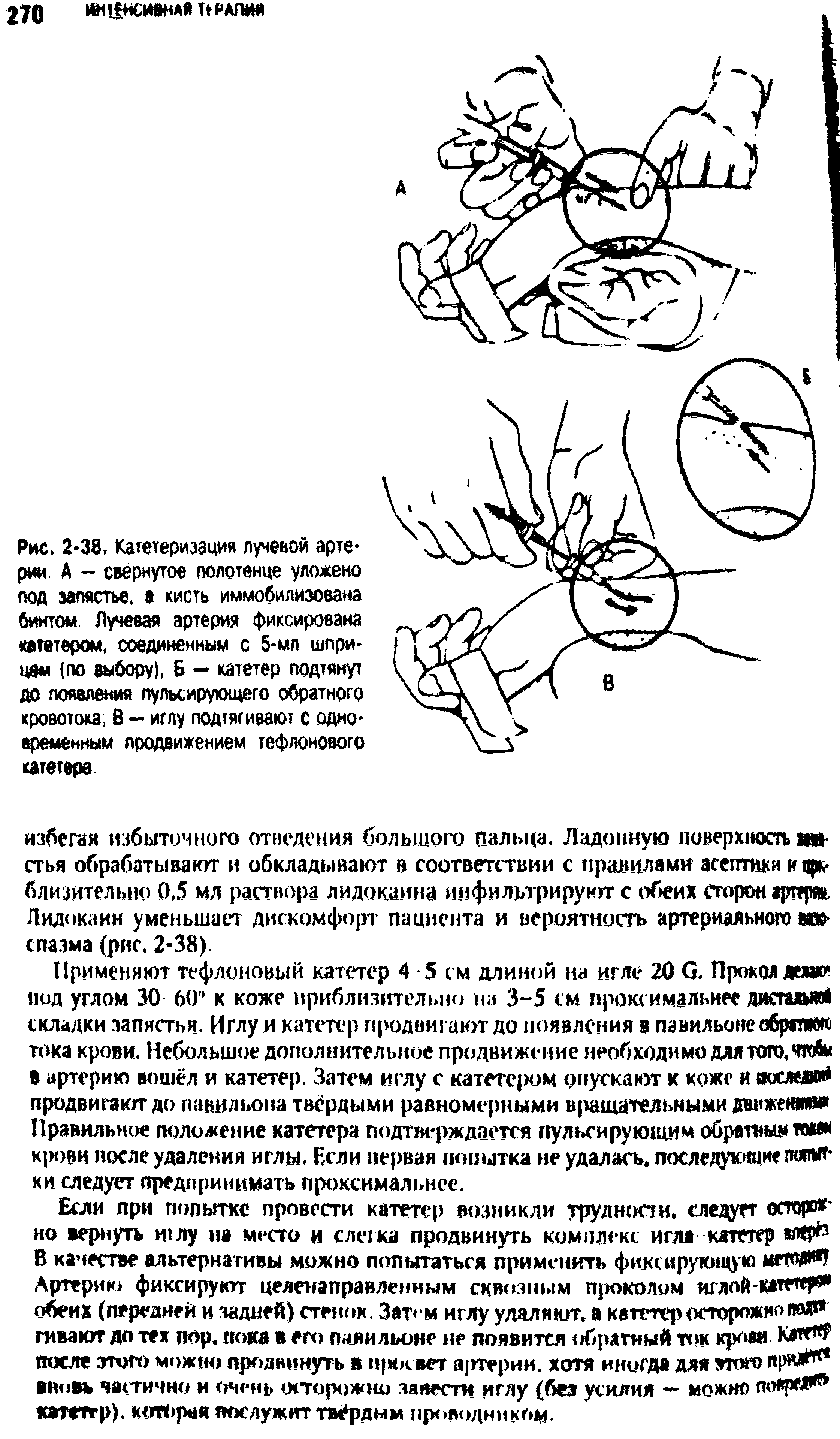 Рис. 2 38. Катетеризация лучевой артерии А - свернутое полотенце уложено под запястье, а кисть иммобилизована...