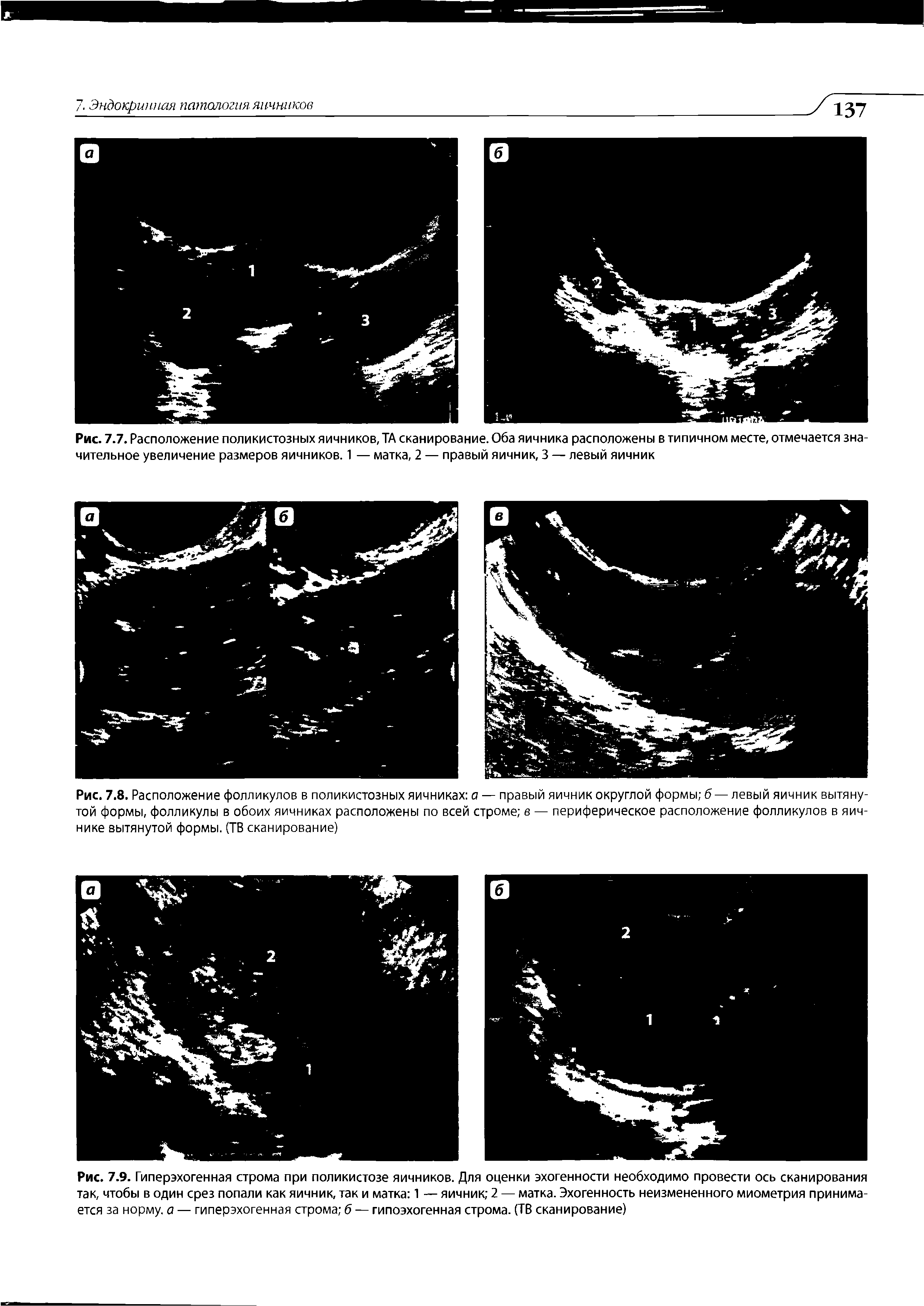 Рис. 7.8. Расположение фолликулов в поликистозных яичниках а — правый яичник округлой формы б — левый яичник вытянутой формы, фолликулы в обоих яичниках расположены по всей строме в — периферическое расположение фолликулов в яичнике вытянутой формы. (ТВ сканирование)...
