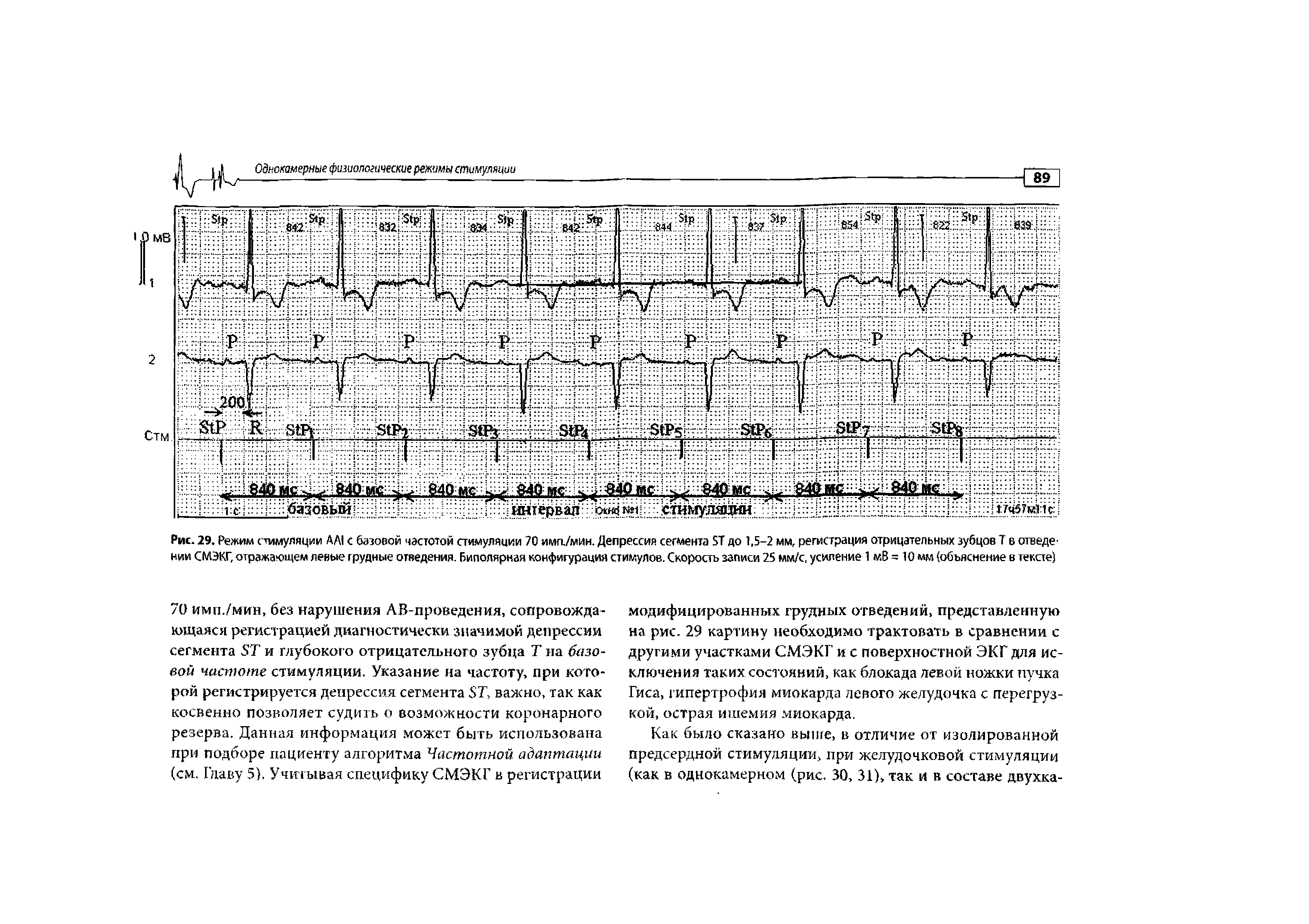 Рис. 29. Режим стимуляции АЛ1 с базовой частотой стимуляции 70 имп./мин. Депрессия сегмента ST до 1,5-2 мм, регистрация отрицательных зубцов Т в отведении СМЭКГ, отражающем левые грудные отведения, биполярная конфигурация стимулов. Скорость записи 25 мм/с, усиление 1 мВ - 10 мм (объяснение в тексте)...