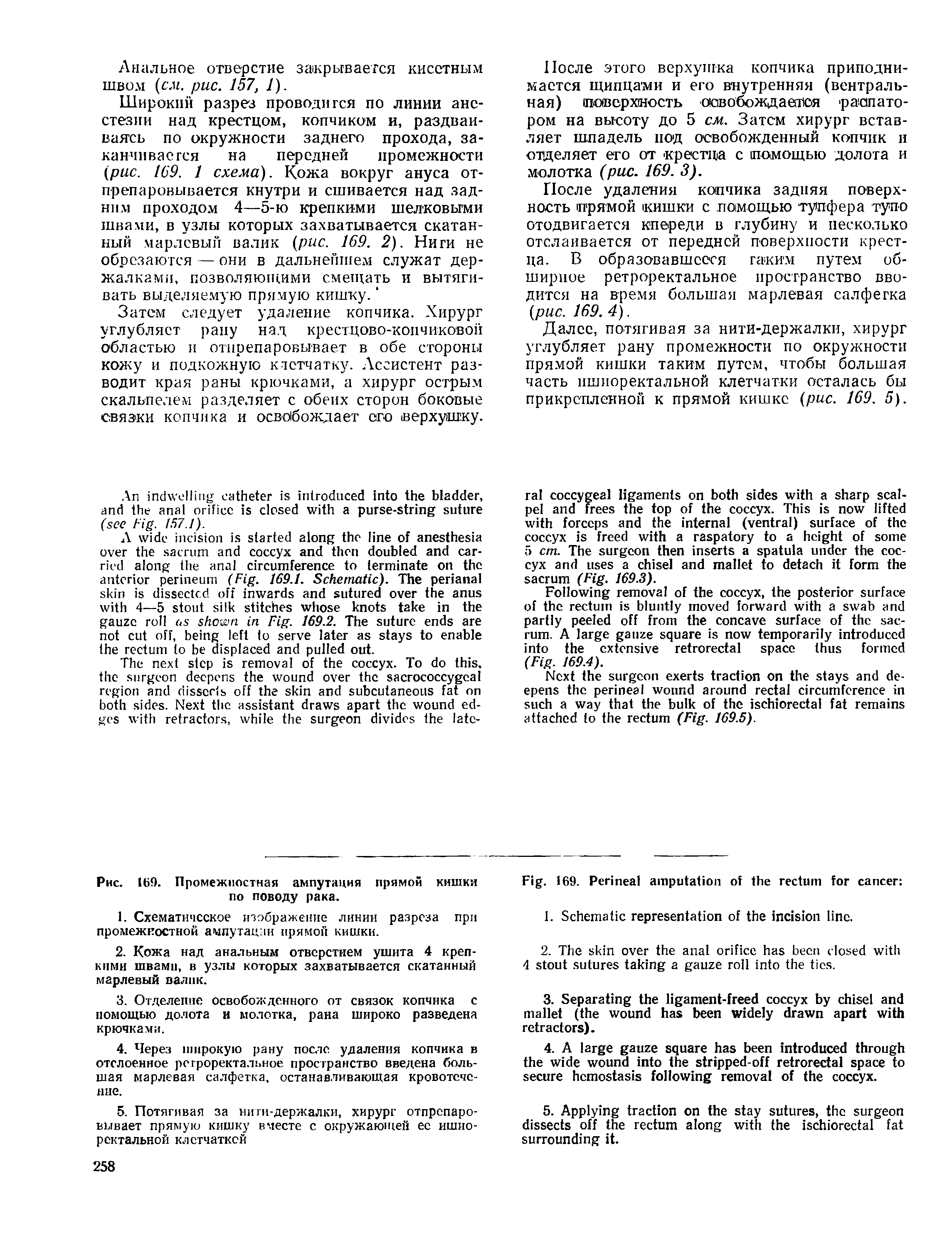 Рис. 169. Промежностная ампутация прямой кишки по поводу рака.