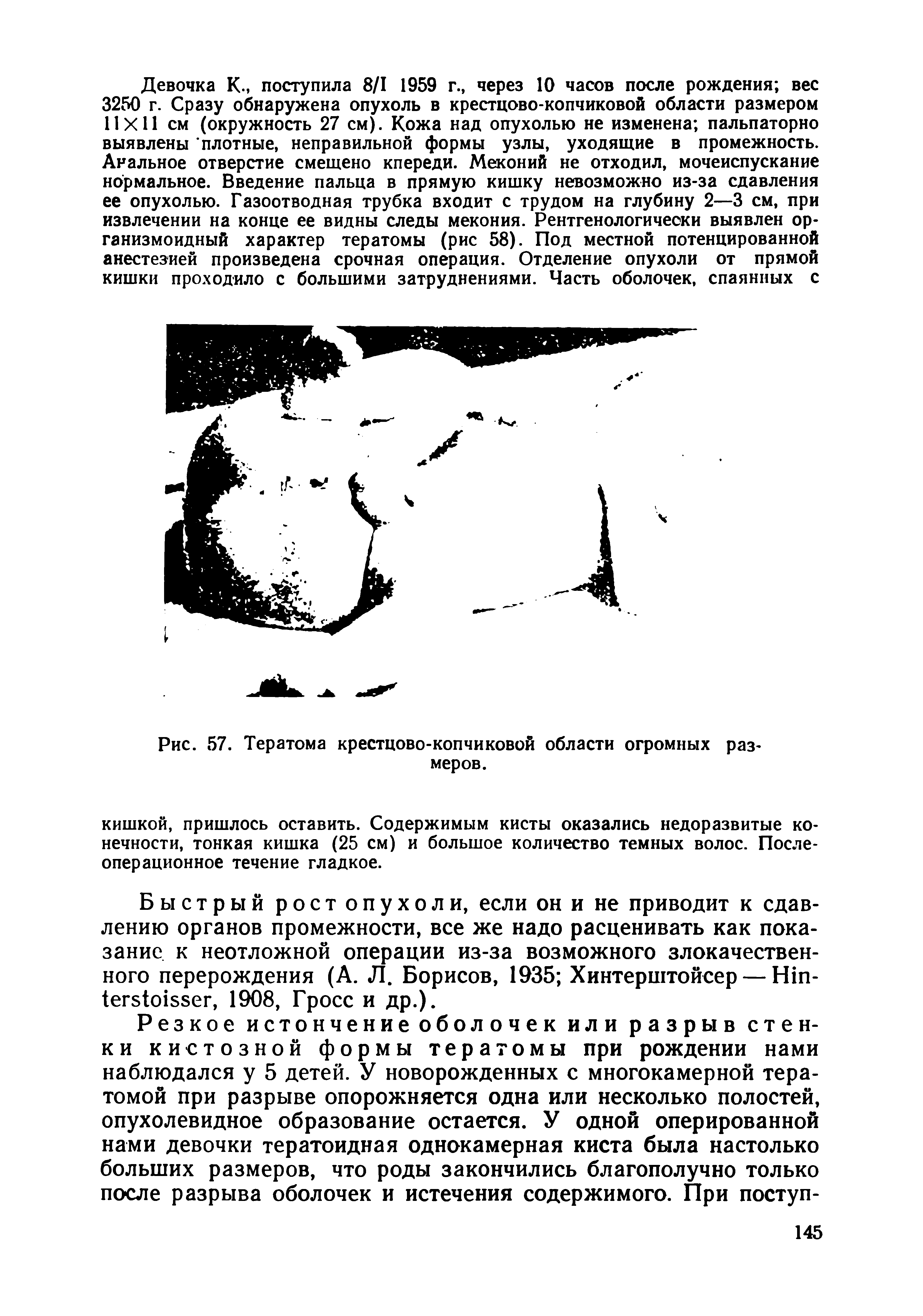 Рис. 57. Тератома крестцово-копчиковой области огромных размеров.