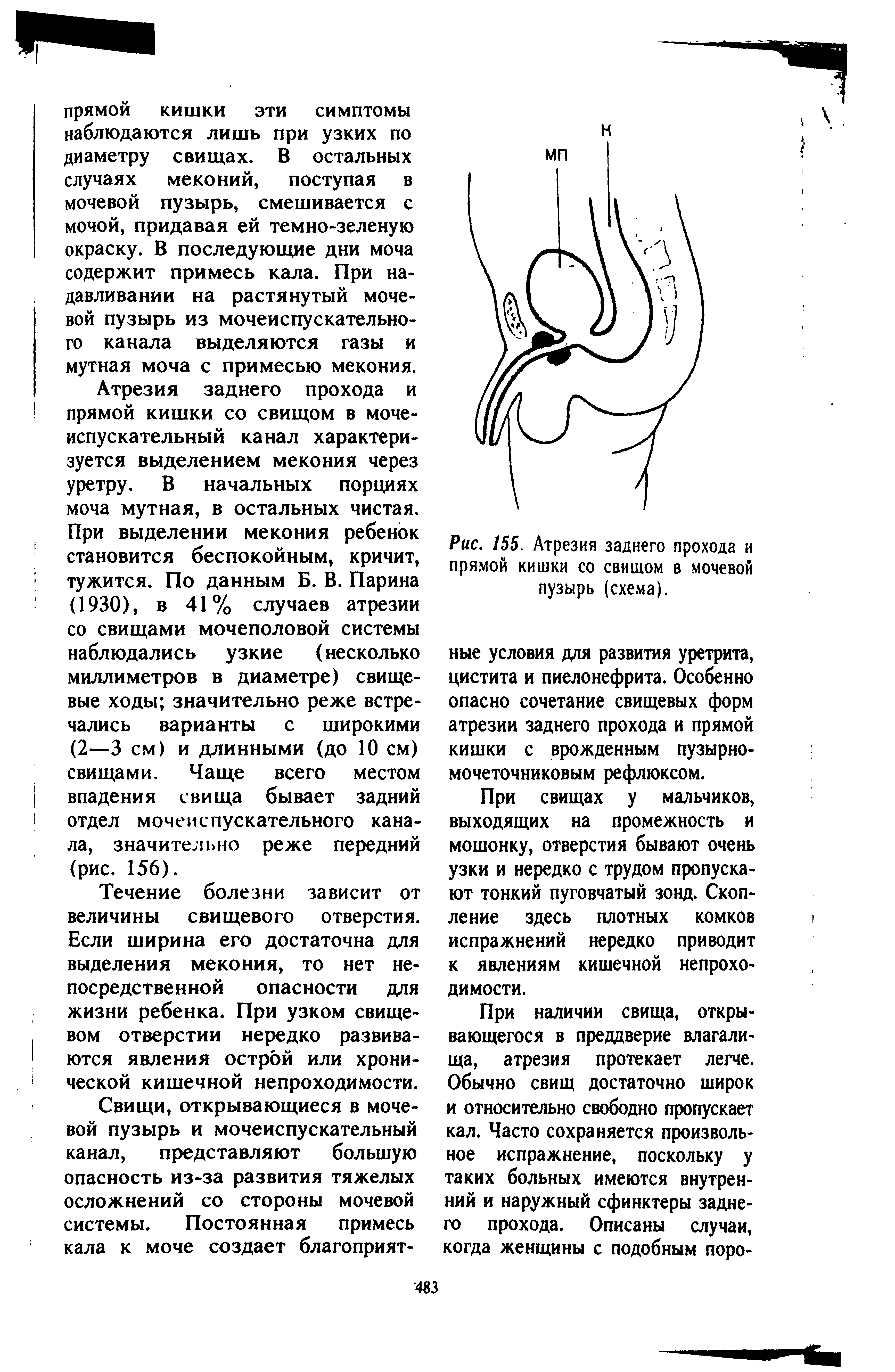 Рис. 155. Атрезия заднего прохода и прямой кишки со свищом в мочевой пузырь (схема).