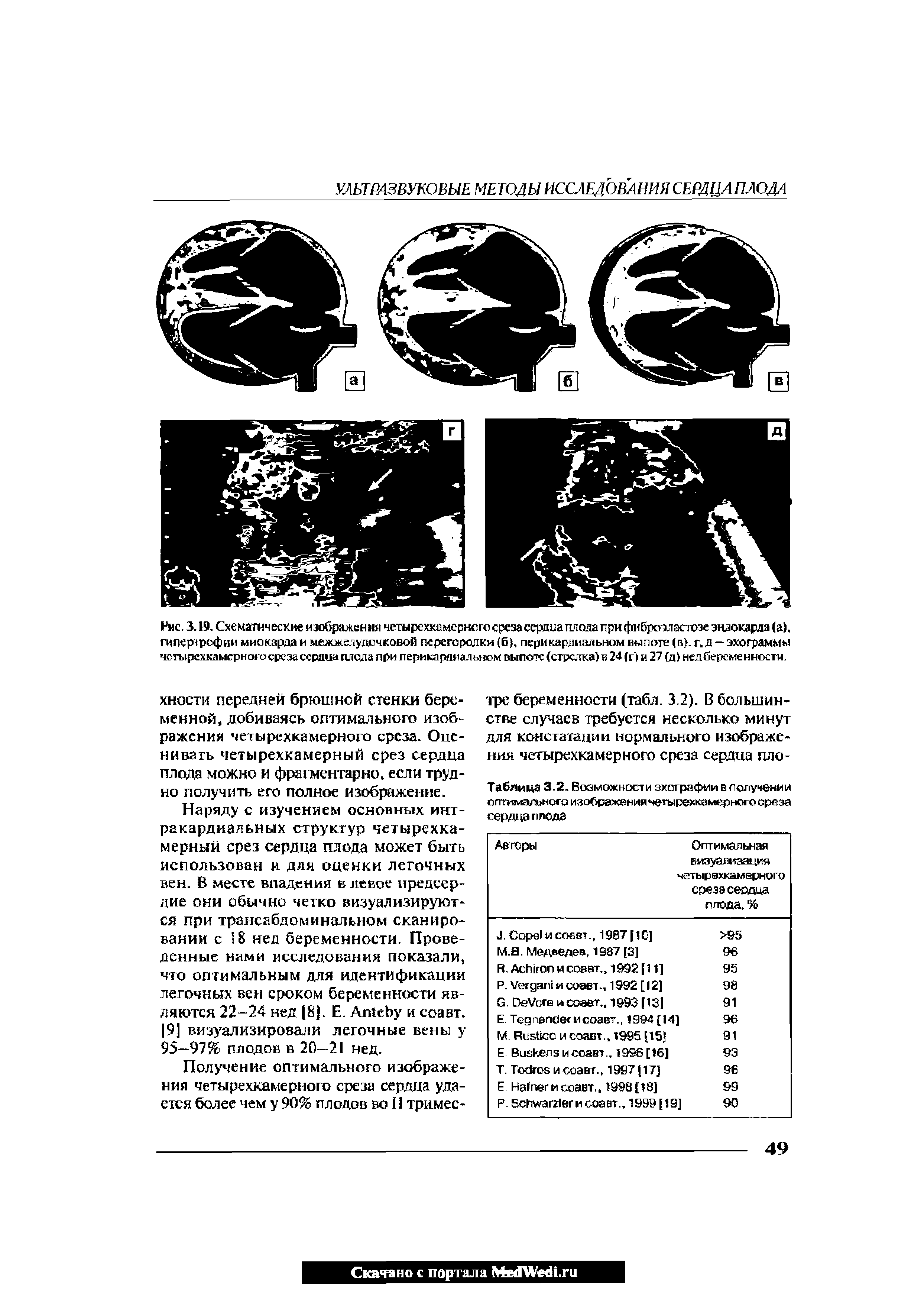 Рис. 3.19. Схематические изображения четырехкамернсго среза сердца плода при фиброэластозе эндокарда (а), гипертрофии миокардам межжелудочковой перегородки (б, перикардиальном выпоте (в), г. д —эхограммы четырехкамерного среза сердца плода при перикардиальном выпоте (стрелка) в 24 (г) и 27 (д > нед беременности.