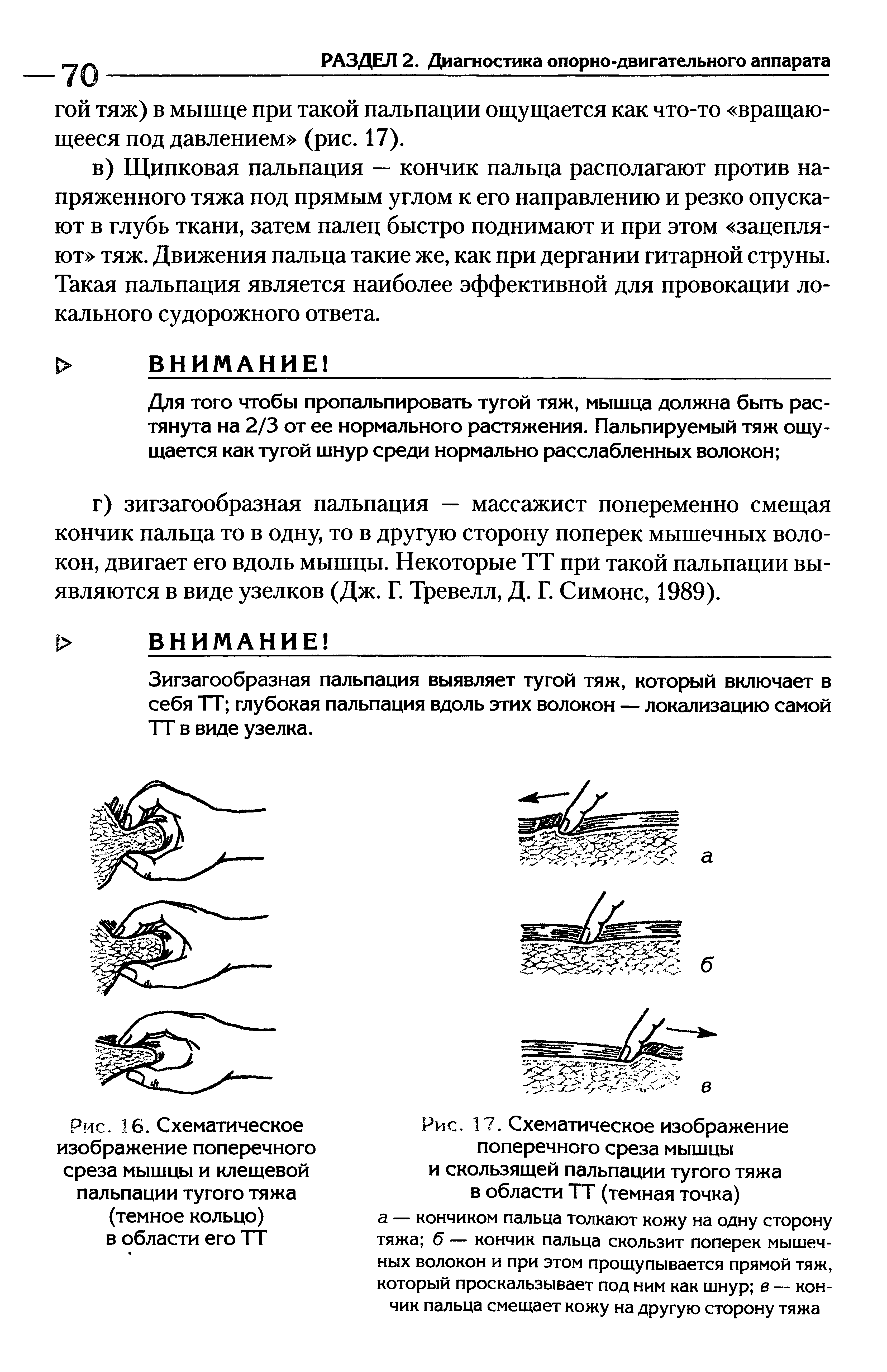 Рис. 16. Схематическое изображение поперечного среза мышцы и клещевой пальпации тугого тяжа (темное кольцо) в области его ТТ...