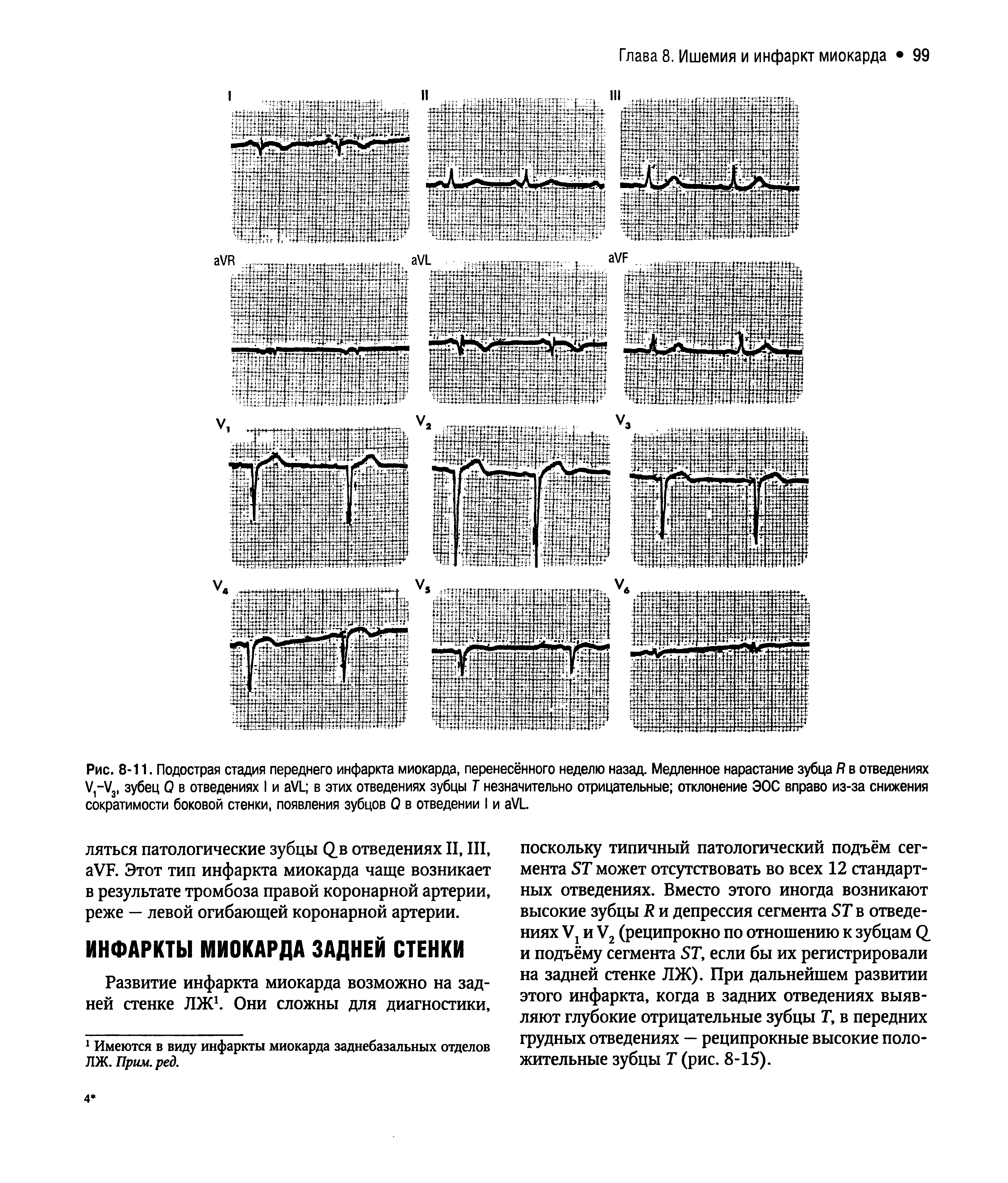 Рис. 8-11. Подострая стадия переднего инфаркта миокарда, перенесённого неделю назад. Медленное нарастание зубца А в отведениях зубец О в отведениях I и аУЦ в этих отведениях зубцы Т незначительно отрицательные отклонение ЭОС вправо из-за снижения сократимости боковой стенки, появления зубцов О в отведении I и аУЬ...