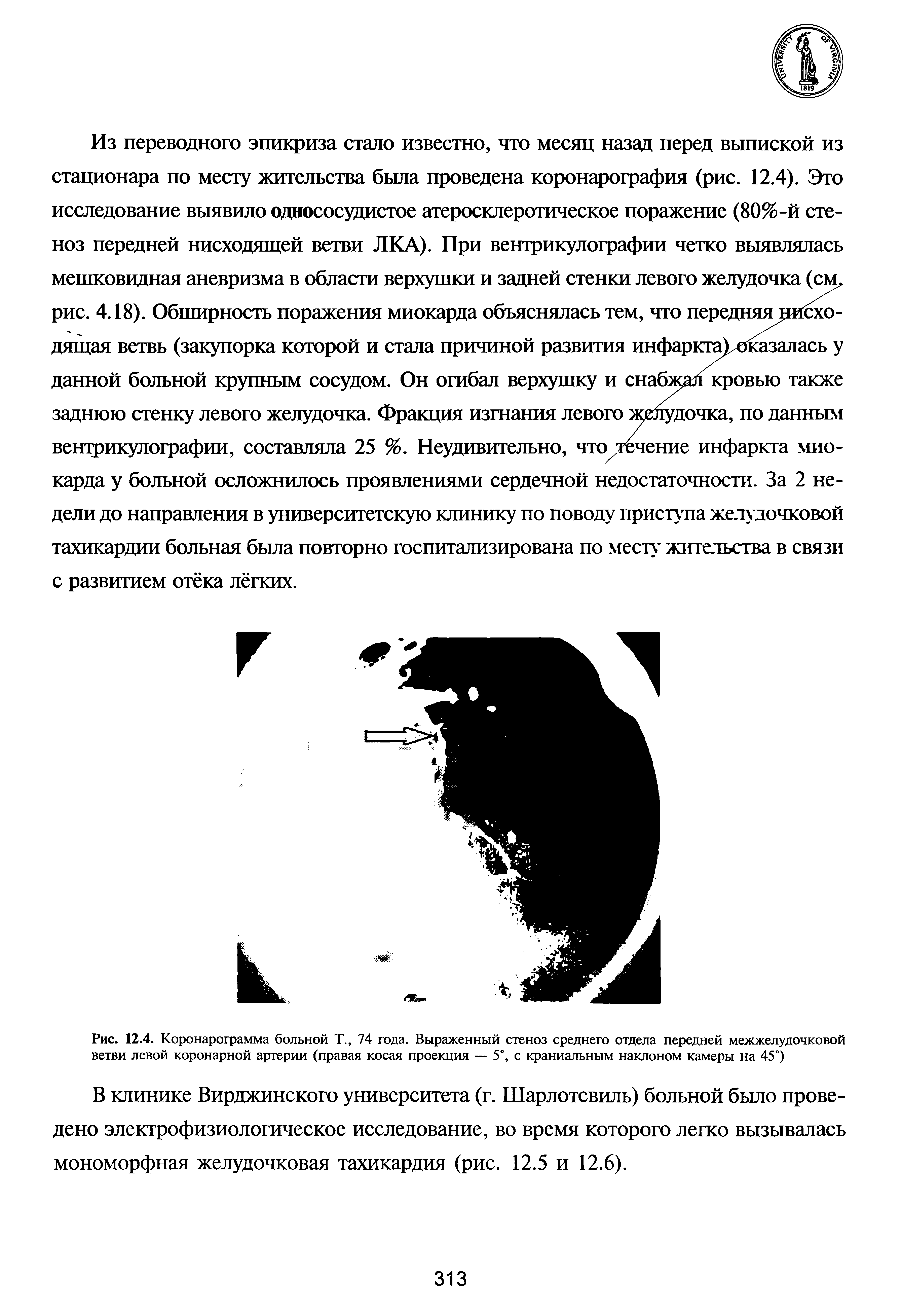 Рис. 12.4. Коронарограмма больной Т., 74 года. Выраженный стеноз среднего отдела передней межжелудочковой ветви левой коронарной артерии (правая косая проекция — 5°, с краниальным наклоном камеры на 45°)...