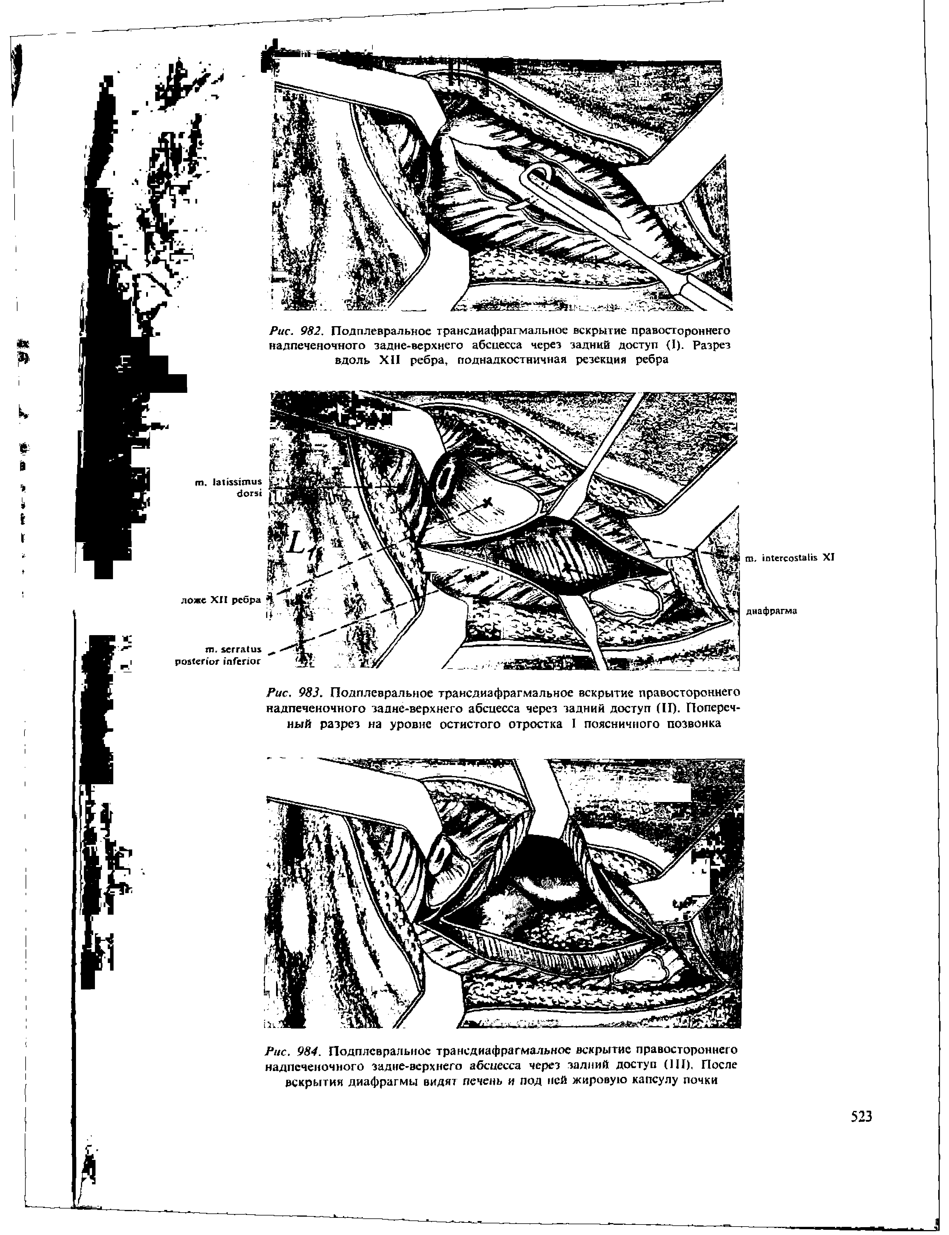 Рис. 983. Подплевральное трансдиафрагмальное вскрытие правостороннего надпеченочного задне-верхнего абсцесса через задний доступ (II). Поперечный разрез...