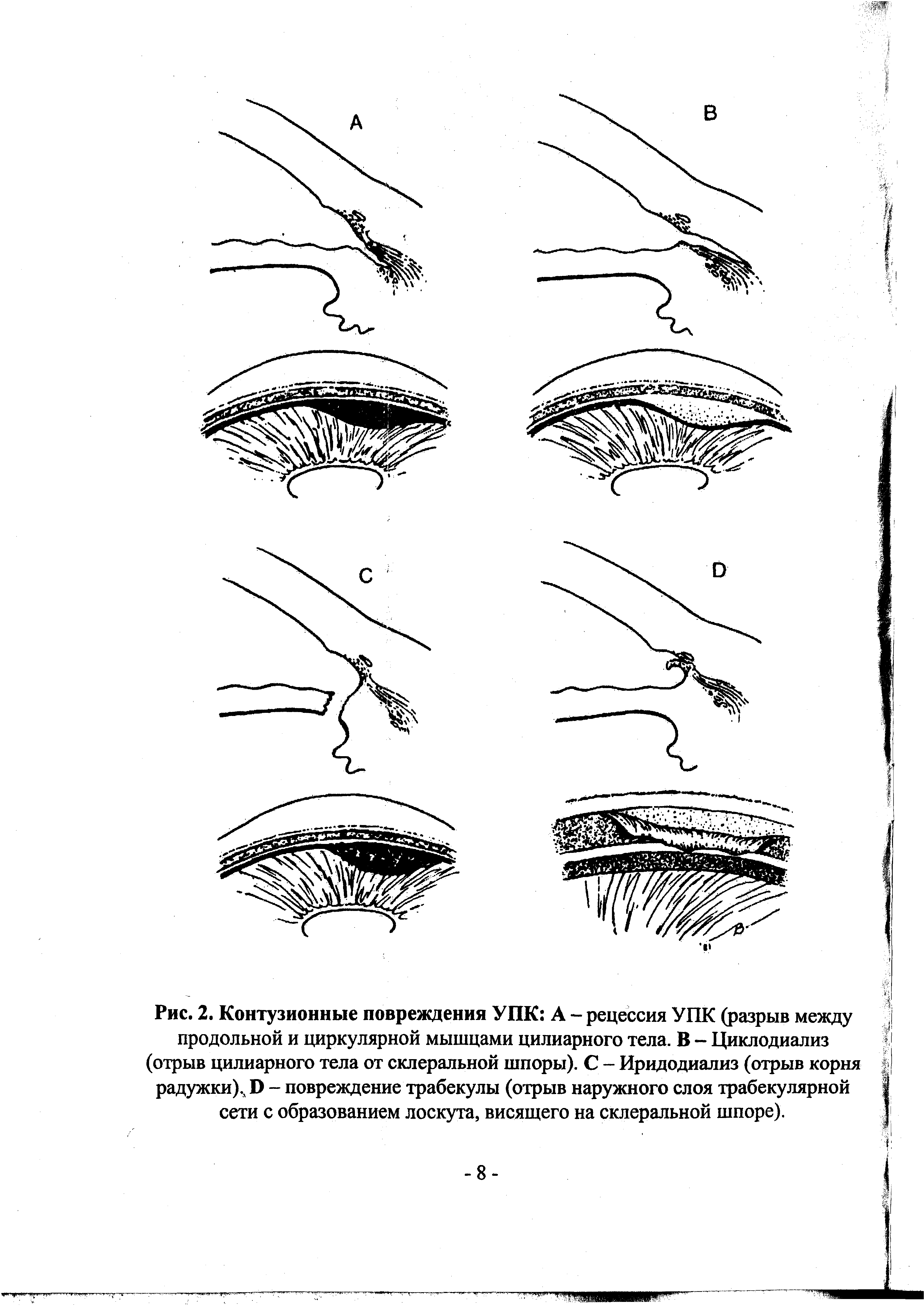 Рис. 2. Контузионные повреждения УПК А - рецессия УПК (разрыв между продольной и циркулярной мышцами цилиарного тела. В - Циклодиализ (отрыв цилиарного тела от склеральной шпоры). С - Иридодиализ (отрыв корня >1 радужки).л П - повреждение трабекулы (отрыв наружного слоя трабекулярной ...