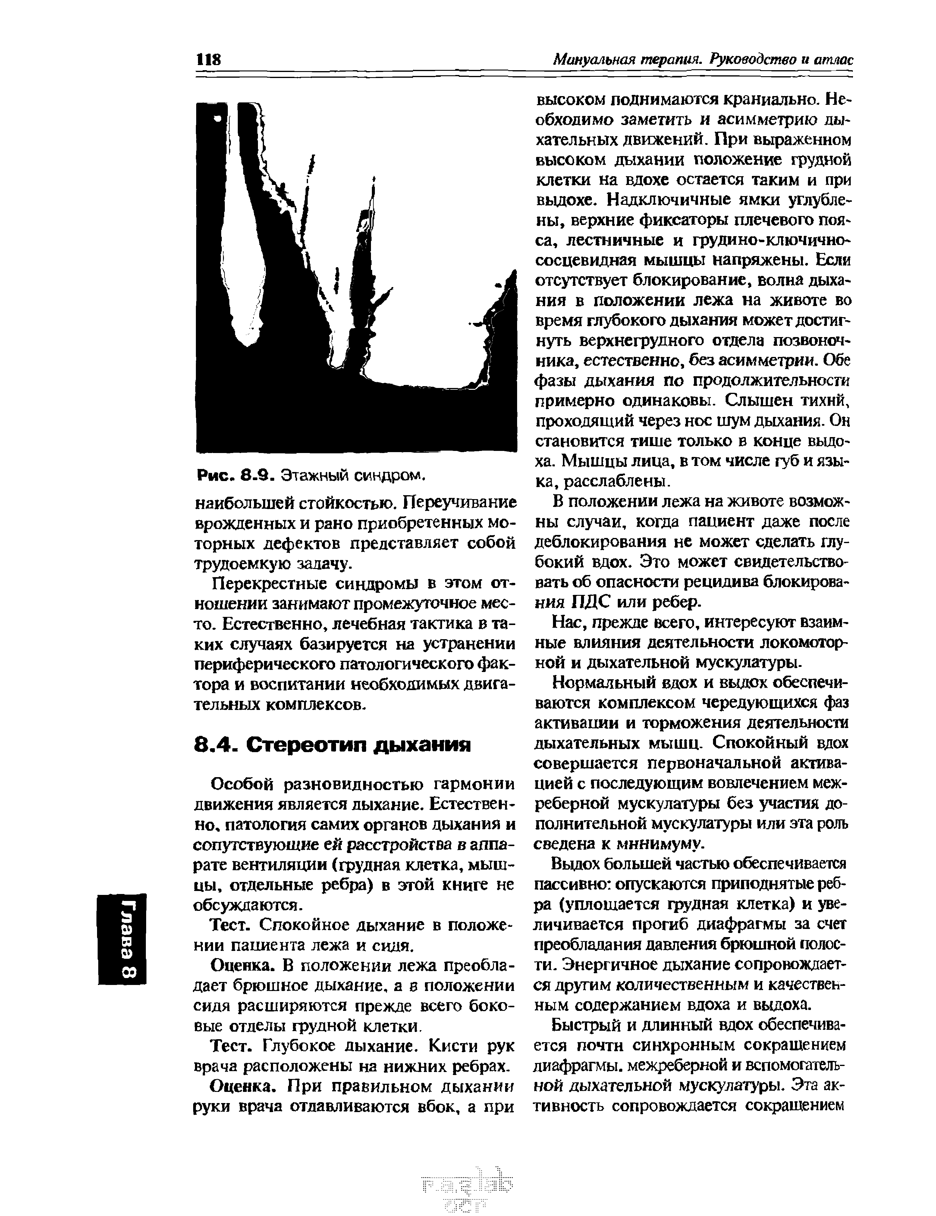 Рис. 8.9. Этажный синдром, наибольшей стойкостью. Переучивание врожденных и рано приобретенных моторных дефектов представляет собой трудоемкую задачу.