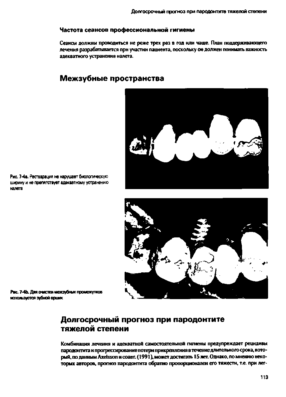 Рис. 4а. Реставрация не нарушает биологическую ширину и не препятствует адекватному устранению...