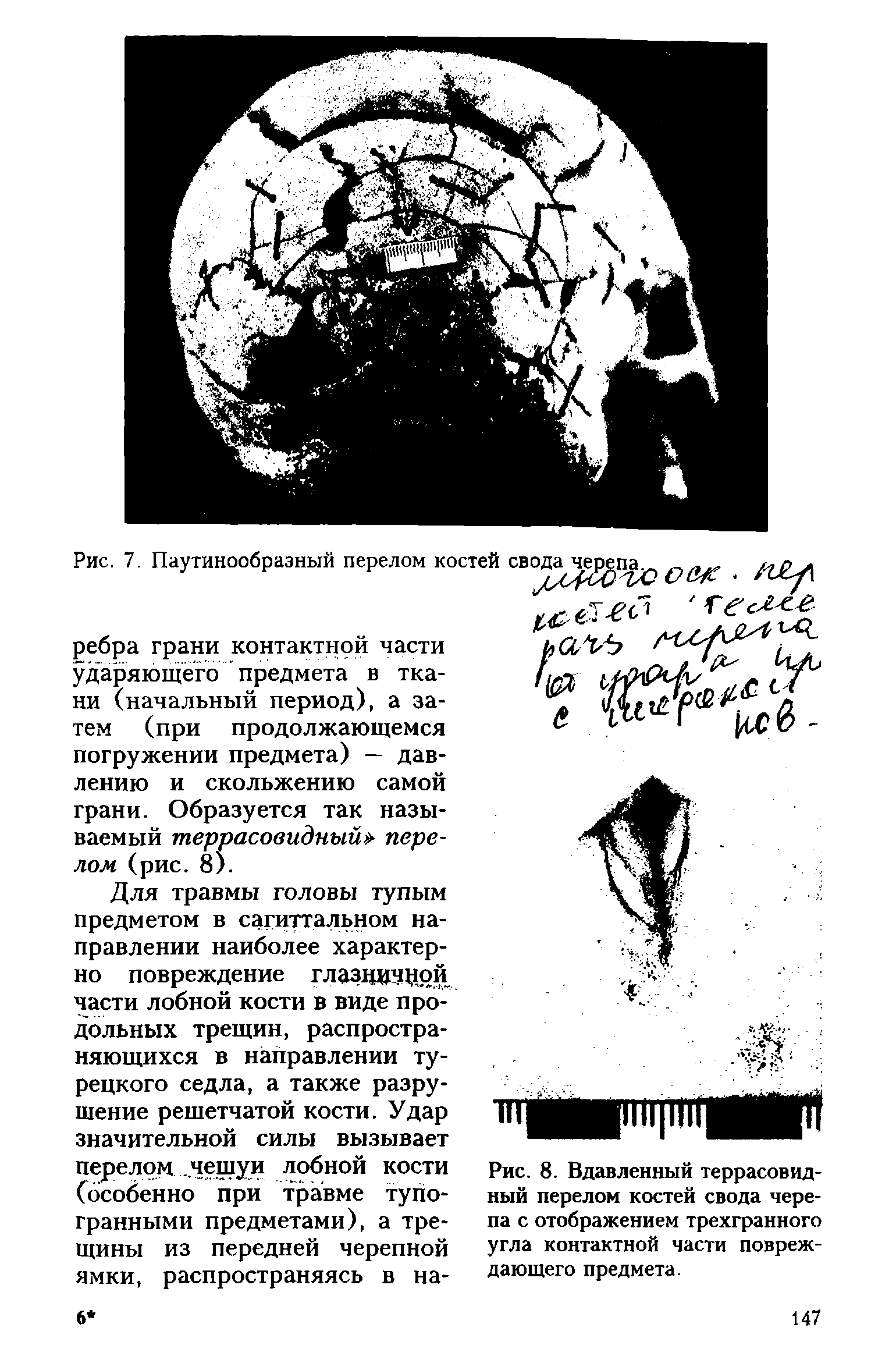 Рис. 8. Вдавленный террасовидный перелом костей свода черепа с отображением трехгранного угла контактной части повреждающего предмета.