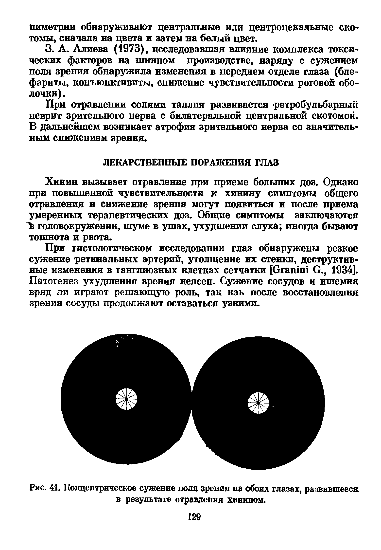 Рис. 41. Концентрическое сужение поля зрения на обоих глазах, развившееся в результате отравления хинином.