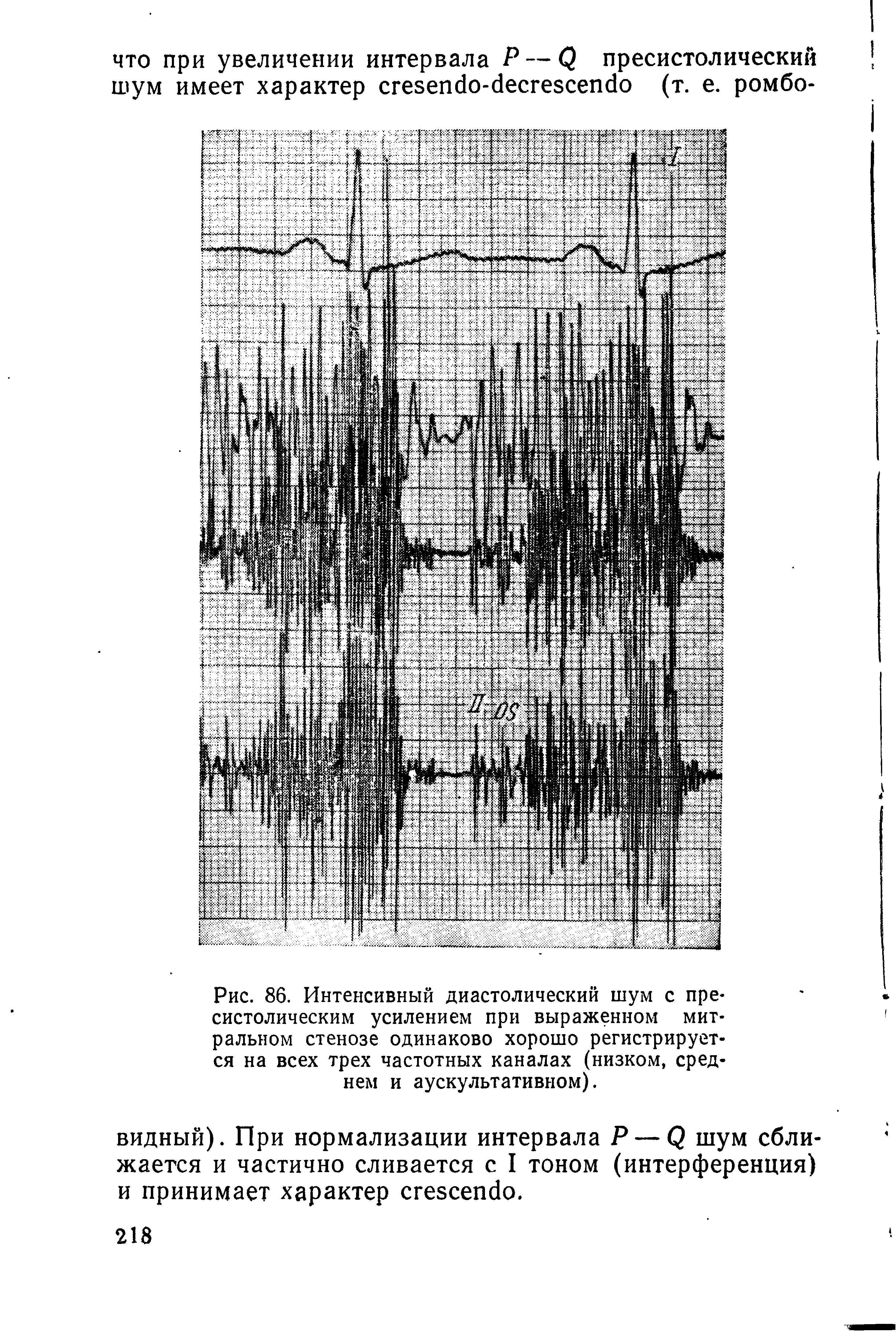 Рис. 86. Интенсивный диастолический шум с пре-систолическим усилением при выраженном митральном стенозе одинаково хорошо регистрируется на всех трех частотных каналах (низком, среднем и аускультативном).