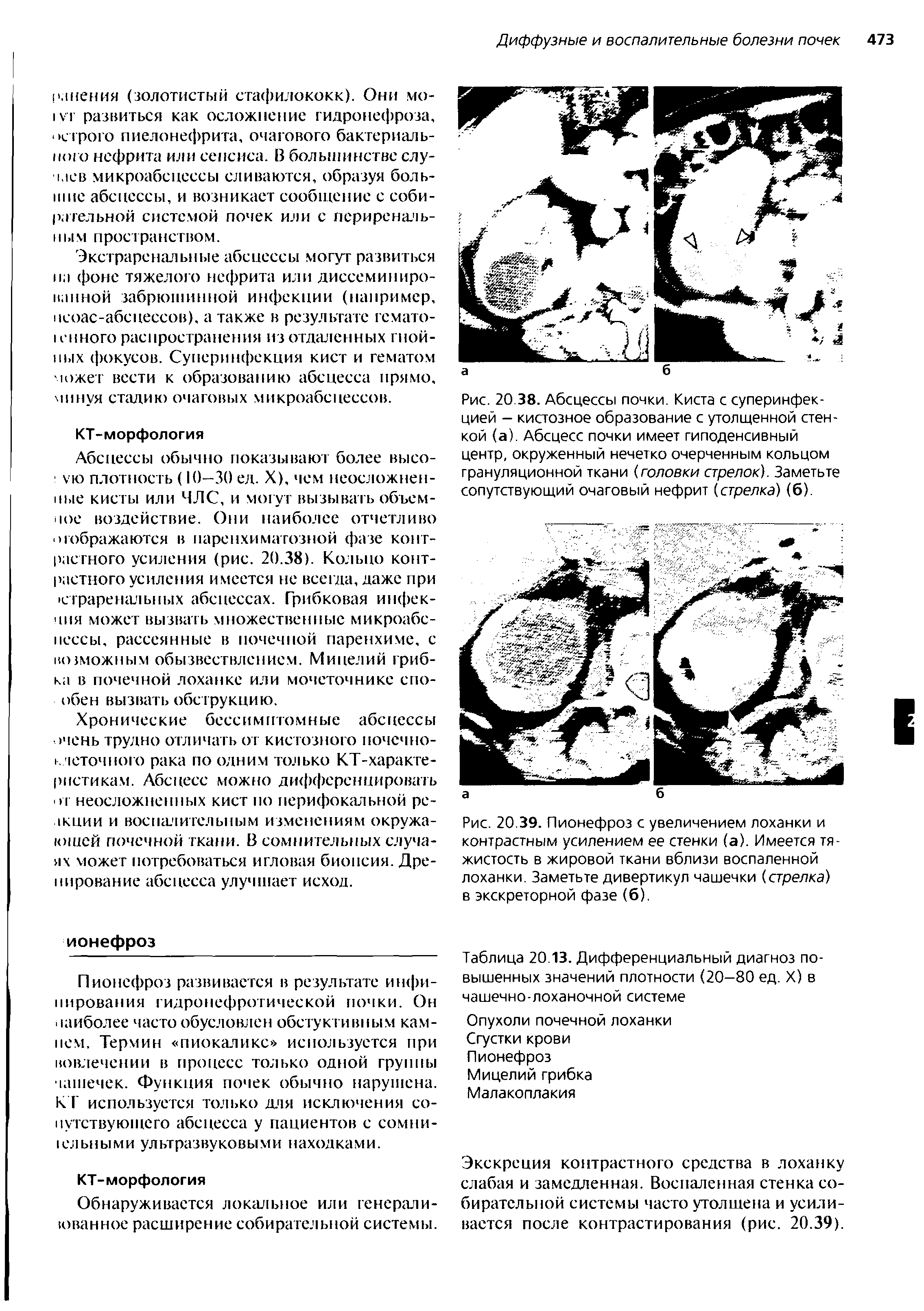 Рис. 20.38. Абсцессы почки. Киста с суперинфекцией - кистозное образование с утолщенной стенкой (а). Абсцесс почки имеет гиподенсивный центр, окруженный нечетко очерченным кольцом грануляционной ткани (головки стрелок). Заметьте сопутствующий очаговый нефрит (стрелка) (6).