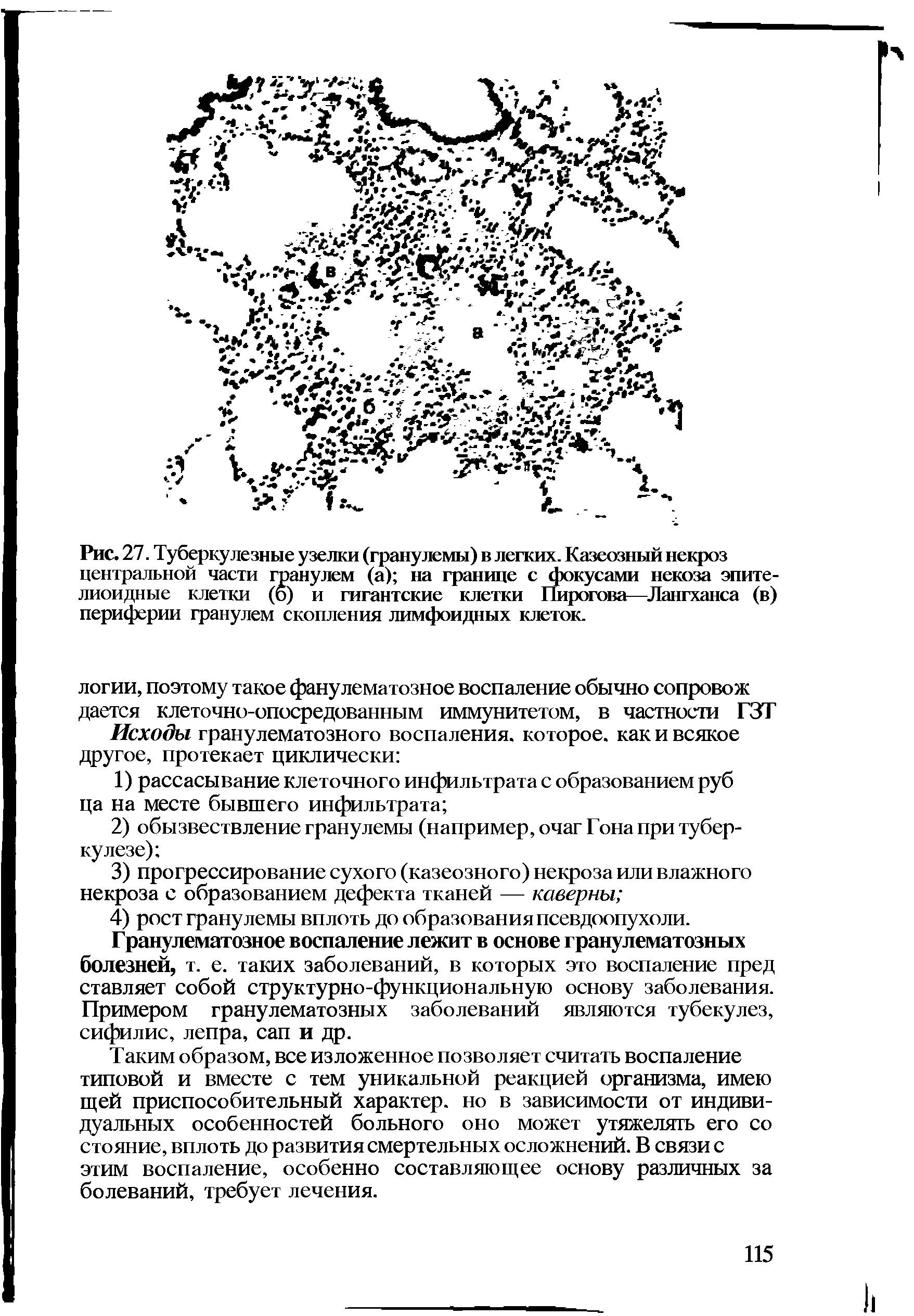 Рис. 27. Туберкулезные узелки (гранулемы) в легких. Казеозный некроз центральной части гранулем (а) на границе с фокусами некоза эпителиоидные клетки (б) и гигантские клетки Пирогона—Лангханса (в) периферии гранулем скопления лимфоидных клеток.