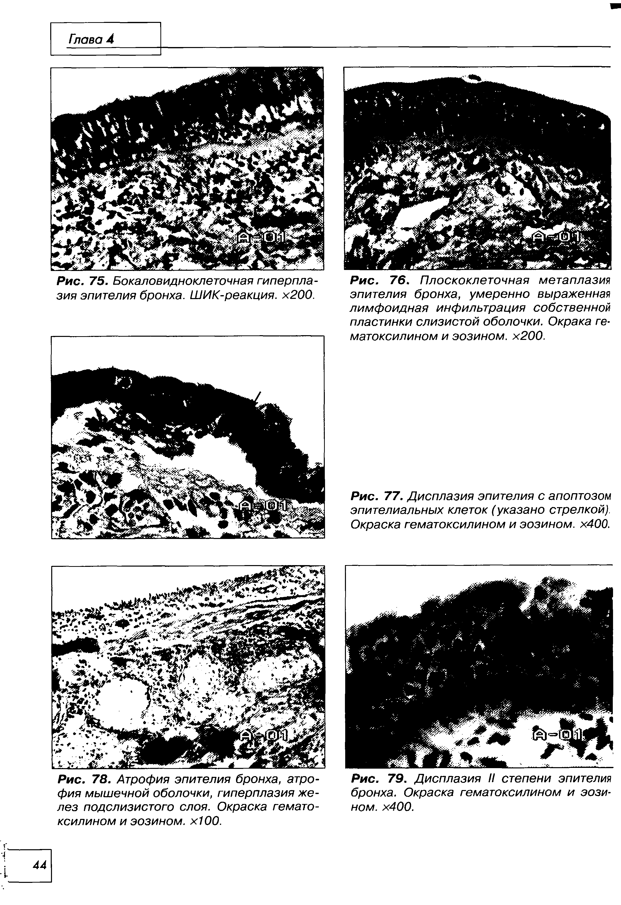 Рис. 78. Атрофия эпителия бронха, атрофия мышечной оболочки, гиперплазия желез подслизистого слоя. Окраска гематоксилином и эозином. хЮО.