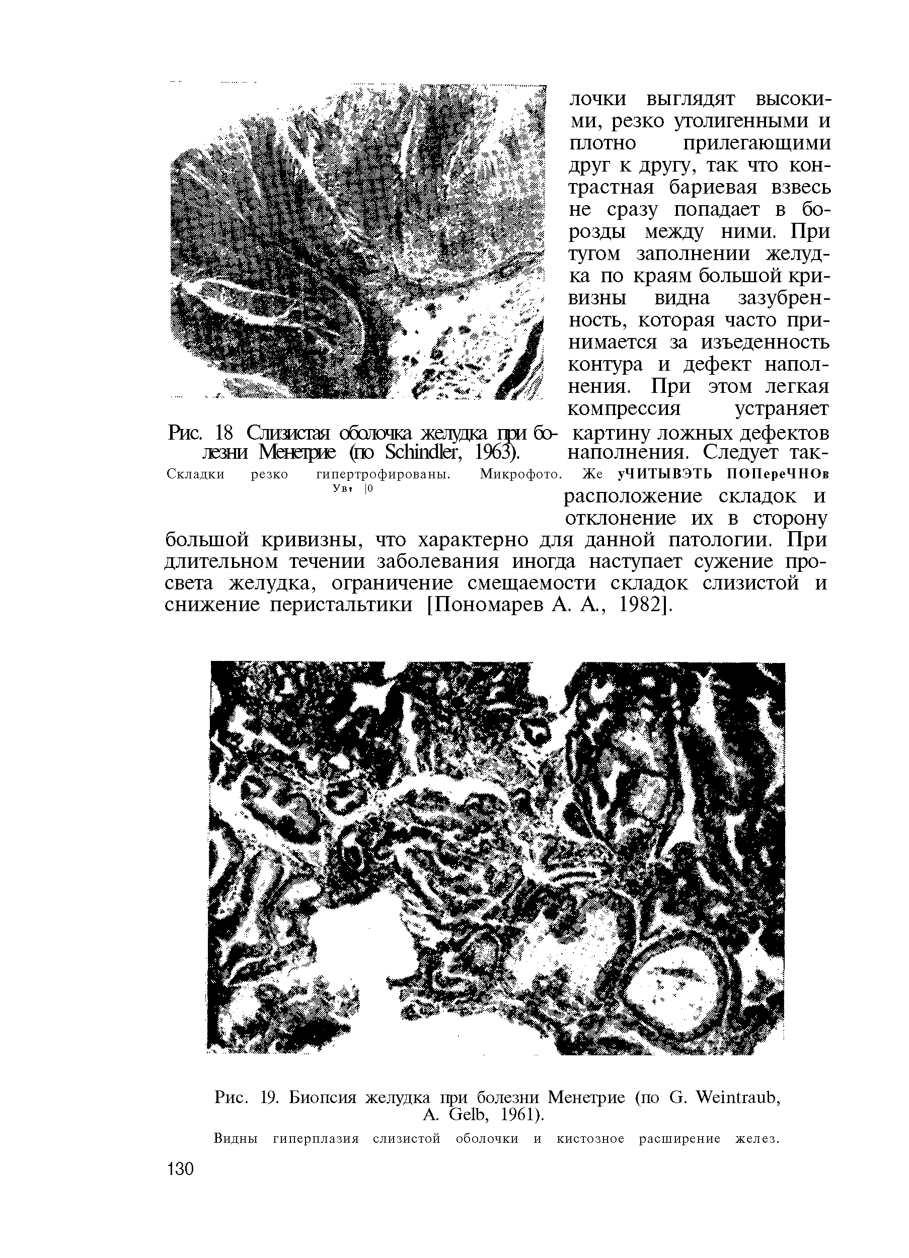 Рис. 19. Биопсия желудка при болезни Менетрие (по G. W , А. G , 1961).