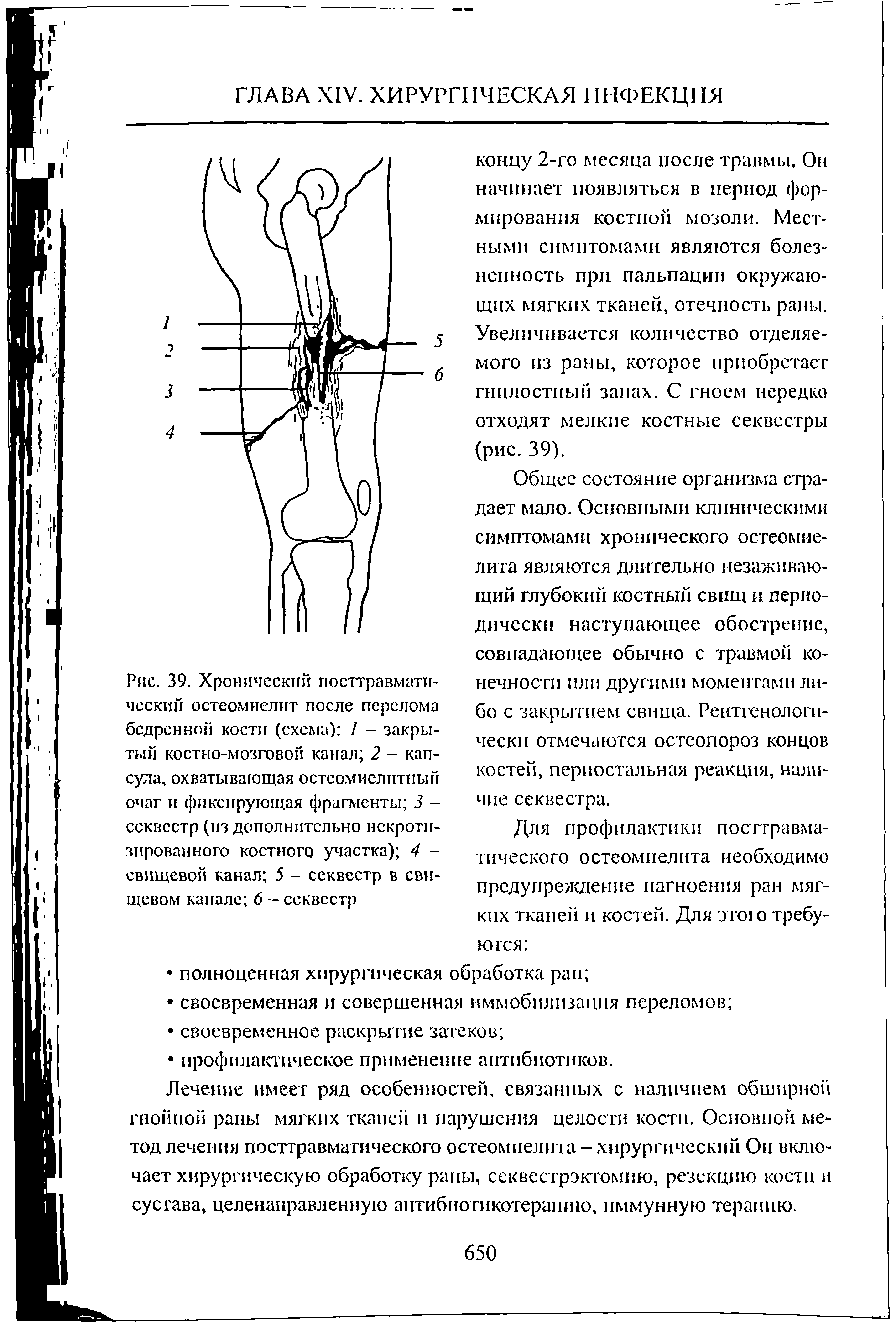 Рис. 39. Хронический посттравматический остеомиелит после перелома бедренной кости (схема) 1 - закрытый костно-мозговой канал 2 - капсула, охватывающая остсомиелитный очаг и фиксирующая фрагменты 3 -секвестр (из дополнительно некротизированного костного участка) 4 -свищевой канал 5 - секвестр в свищевом канале 6 - секвестр...