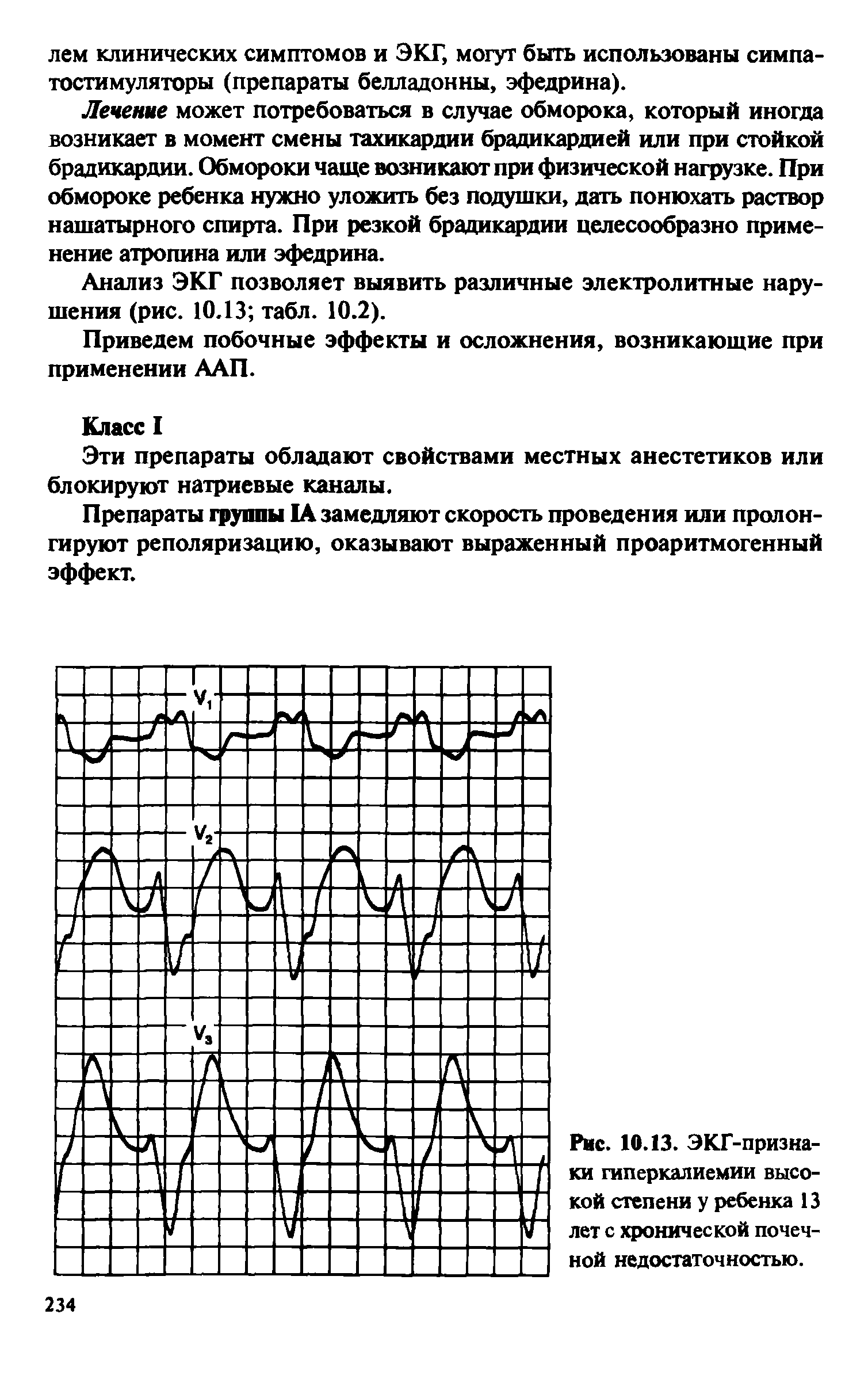 Рис. 10.13. ЭКГ-признаки гиперкалиемии высокой степени у ребенка 13 лет с хронической почечной недостаточностью.