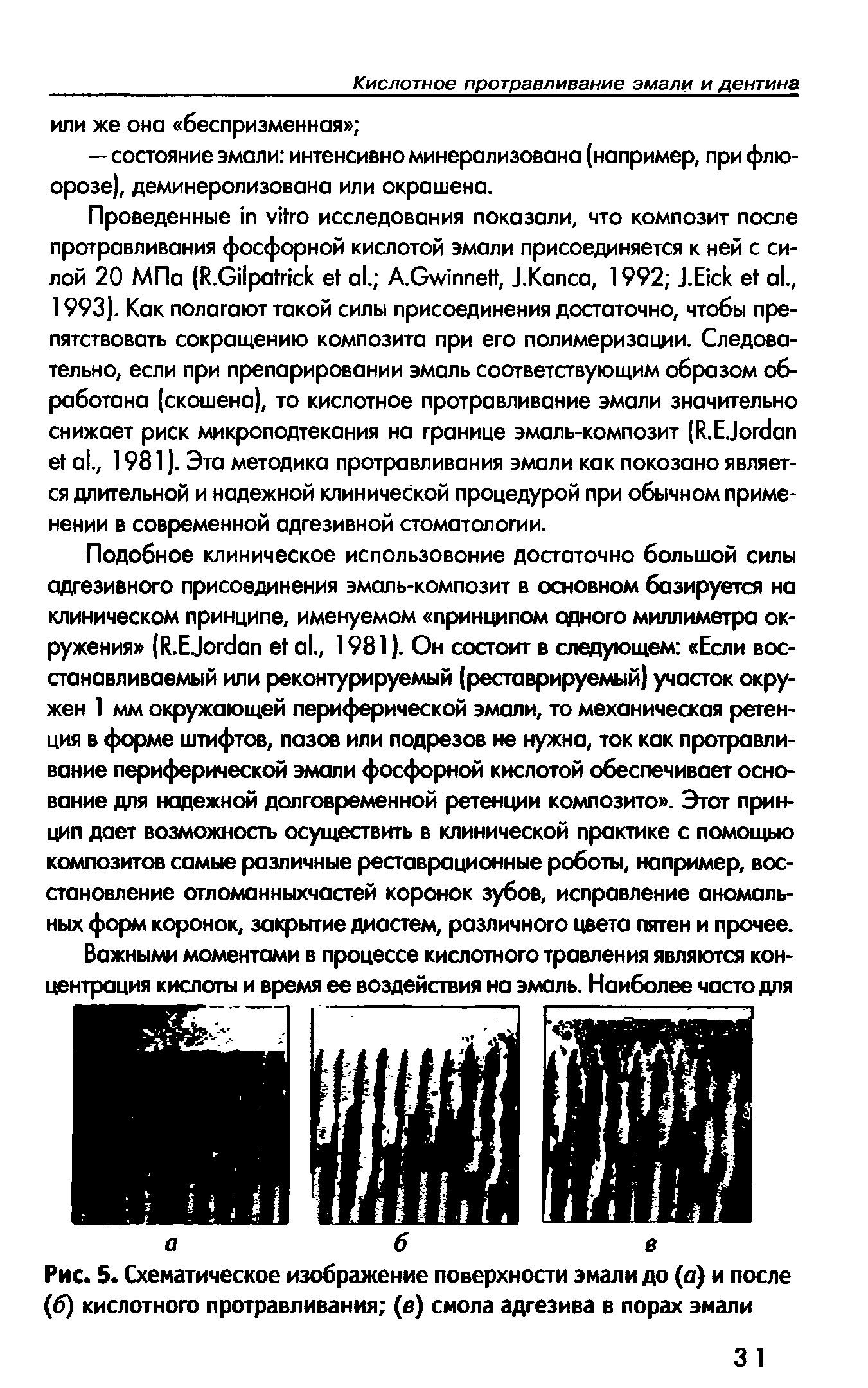 Рис. 5. Схематическое изображение поверхности эмали до (а) и после (б) кислотного протравливания (в) смола адгезива в порах эмали...