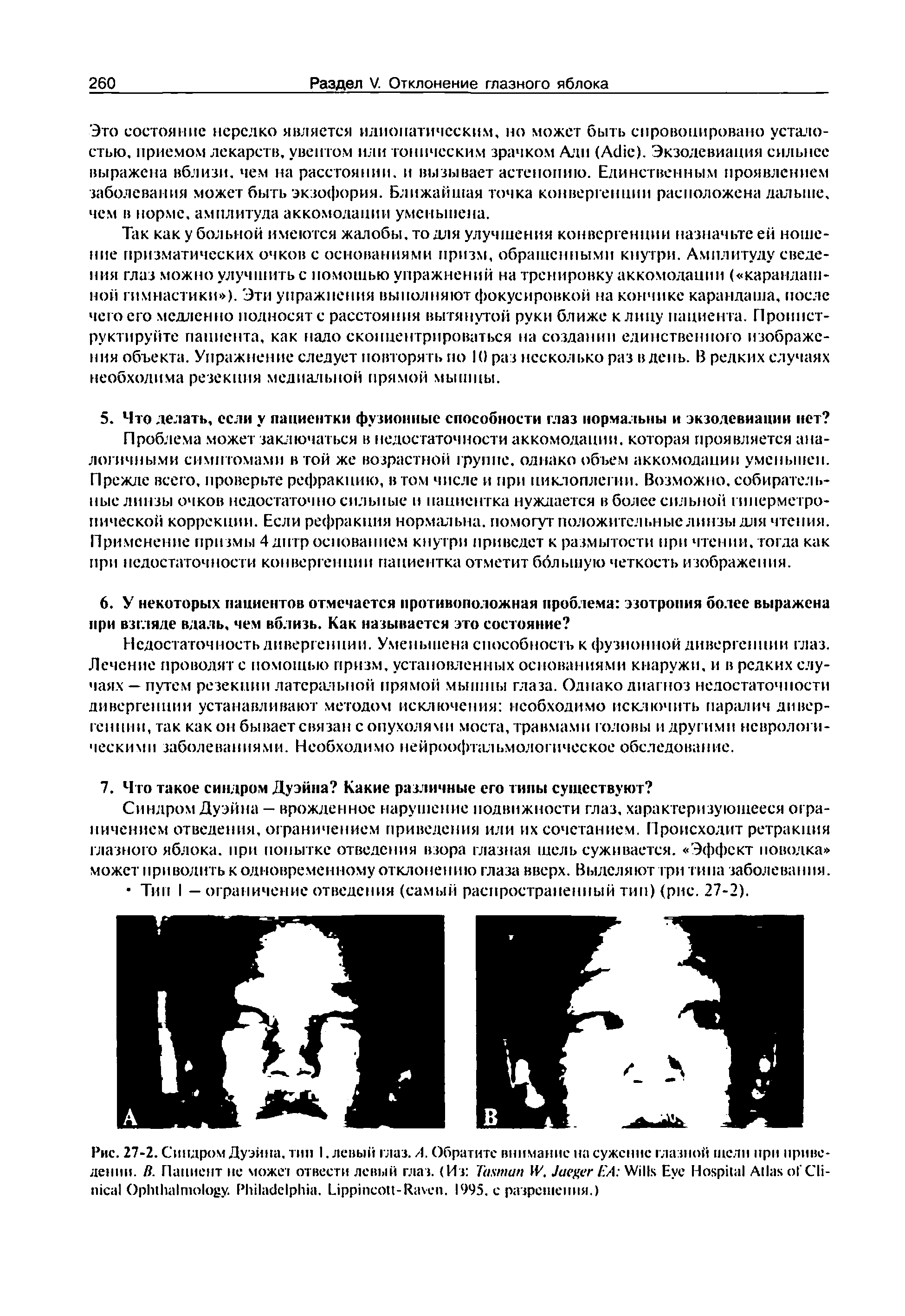 Рис. 27-2. Синдром Дуэйна, тип 1. левый глаз. /1. Обратите внимание на сужение глазной щели при приведении. в. Пациент не можег отвести левый глаз. (Из 7 W. J ЕА W E H A C O . P . L -R . 1995. с разрешения.)...