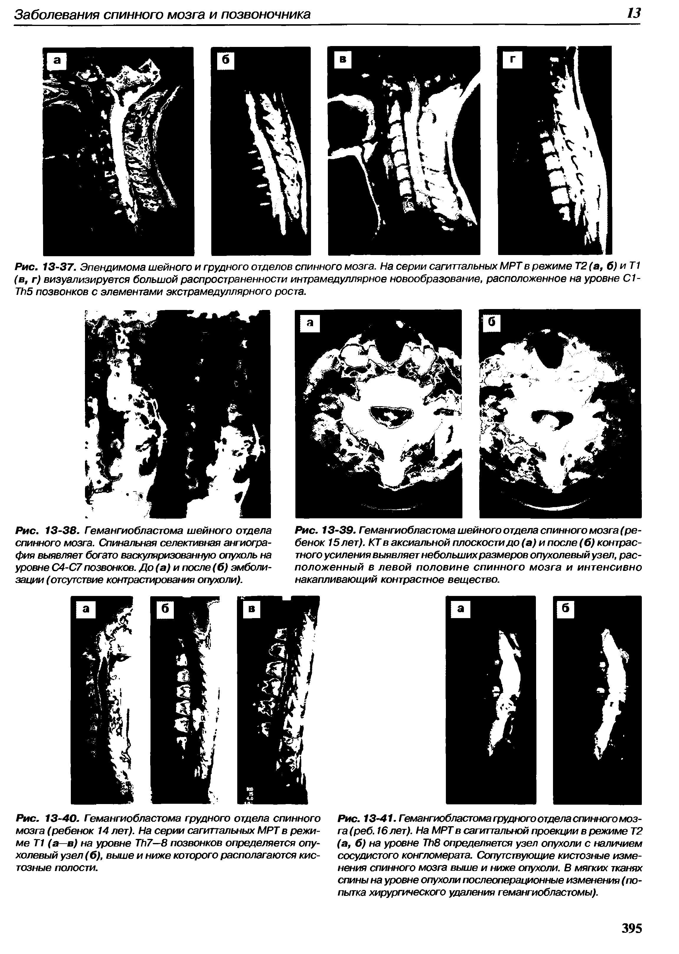 Рис. 13-40. Гемангиобластома грудного отдела спинного мозга (ребенок 14 лет). На серии сагиттальных МРТ в режиме Т1 (а—в) на уровне T 7—8 позвонков определяется опухолевый узел (б), выше и ниже которого располагаются кистозные полости.