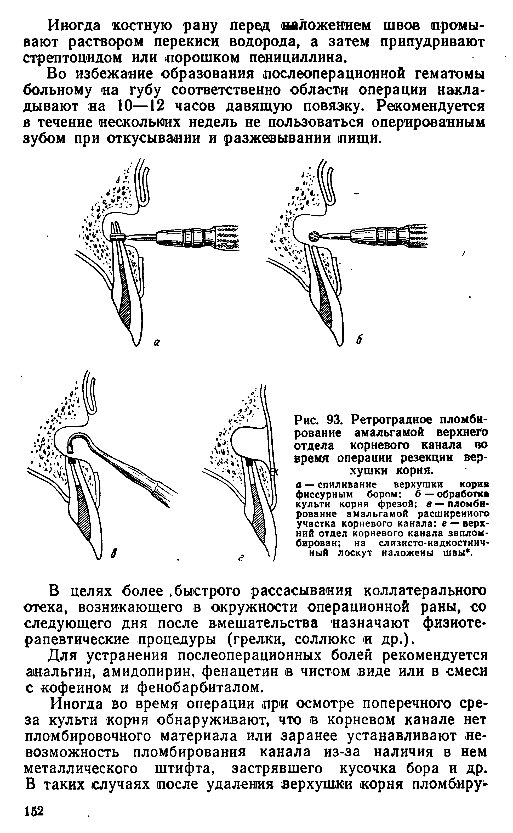 Рис. 93. Ретроградное пломбирование амальгамой верхнего отдела корневого канала во время операции резекции верхушки корня.