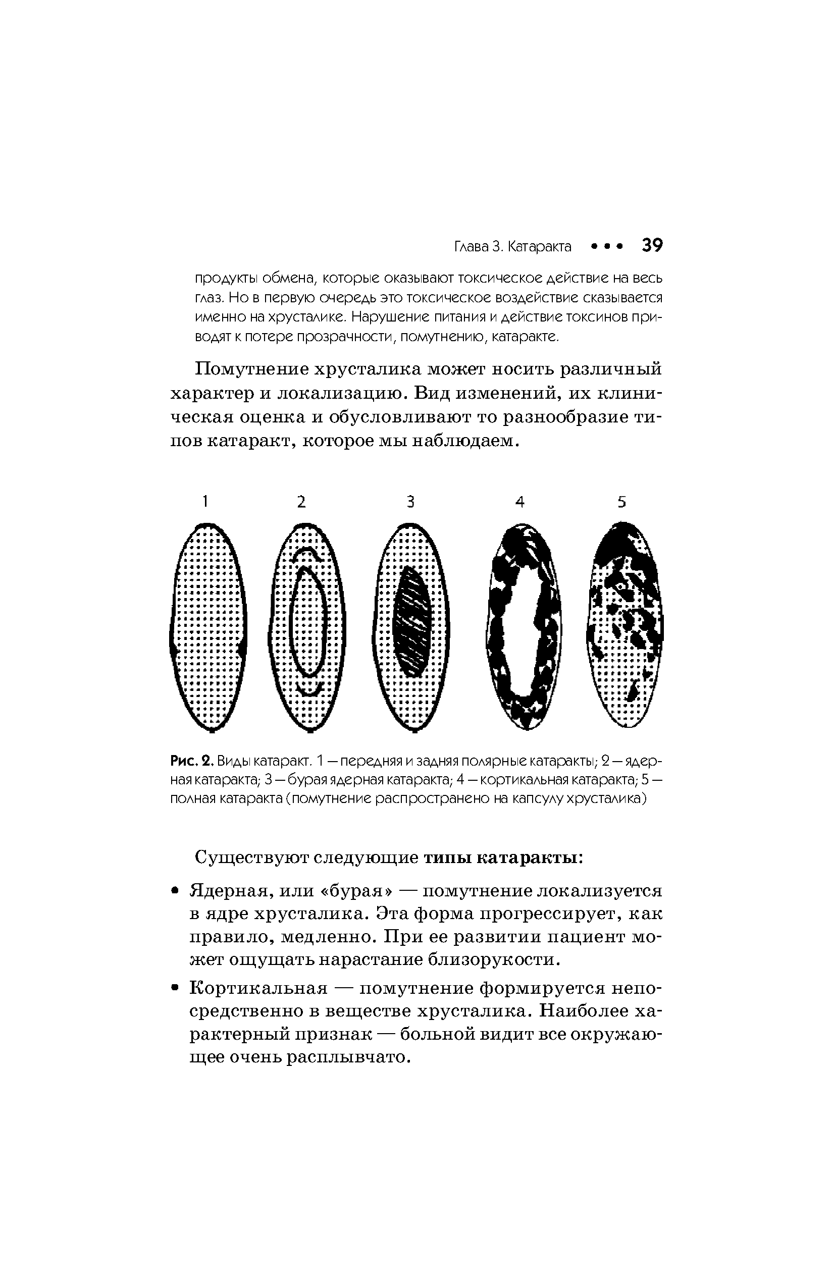 Рис.2. Виды катаракт. 1 — передняя и задняя полярные катаракты 2 —ядер-ная катаракта 3 — бурая ядерная катаракта 4 - кортикальная катаракта 5 — полная катаракта (помутнение распространено на капсулу хрусталика)...