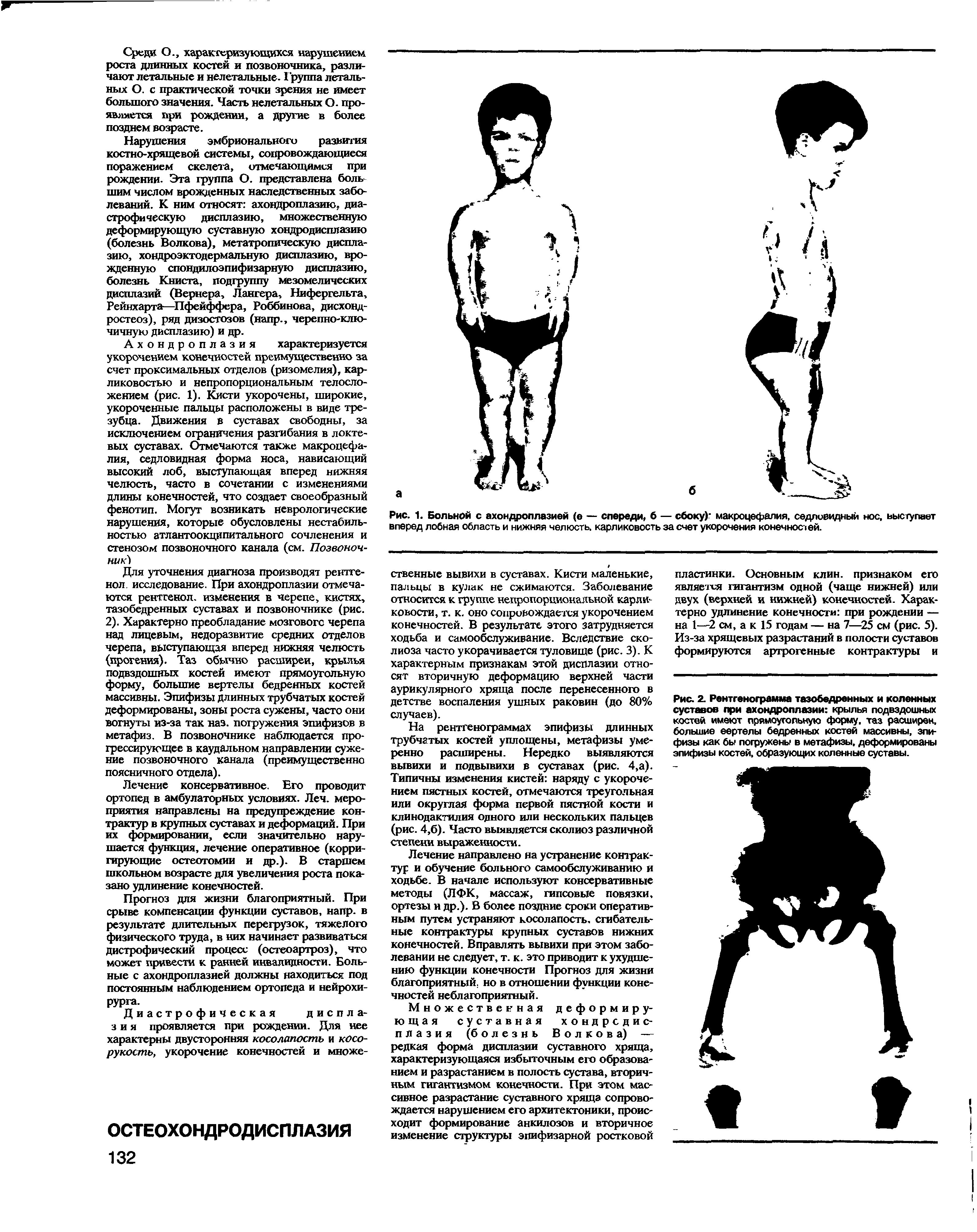 Рис. 1. Больной с ахондроплазией (е — спереди, б — сбоку) макроцефалия, седловидный нос, выступает вперед лобная область и нижняя челюсть, карликовость за счет укорочения конечностей.