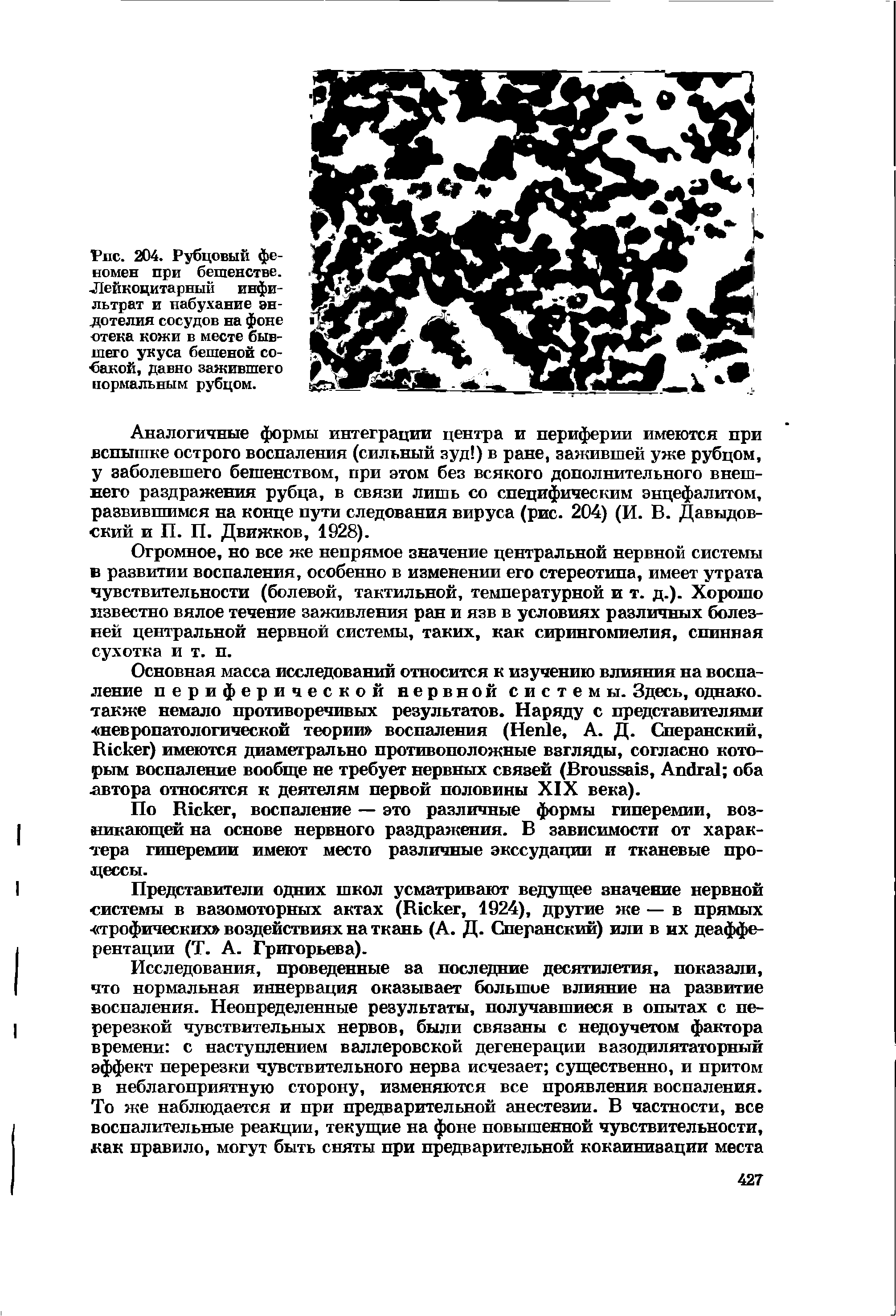 Рис. 204. Рубцовый феномен при бешенстве. Лейкоцитарный инфильтрат и набухание эндотелия сосудов на фоне отека кожи в месте бывшего укуса бешеной собакой, давно зажившего нормальным рубцом.