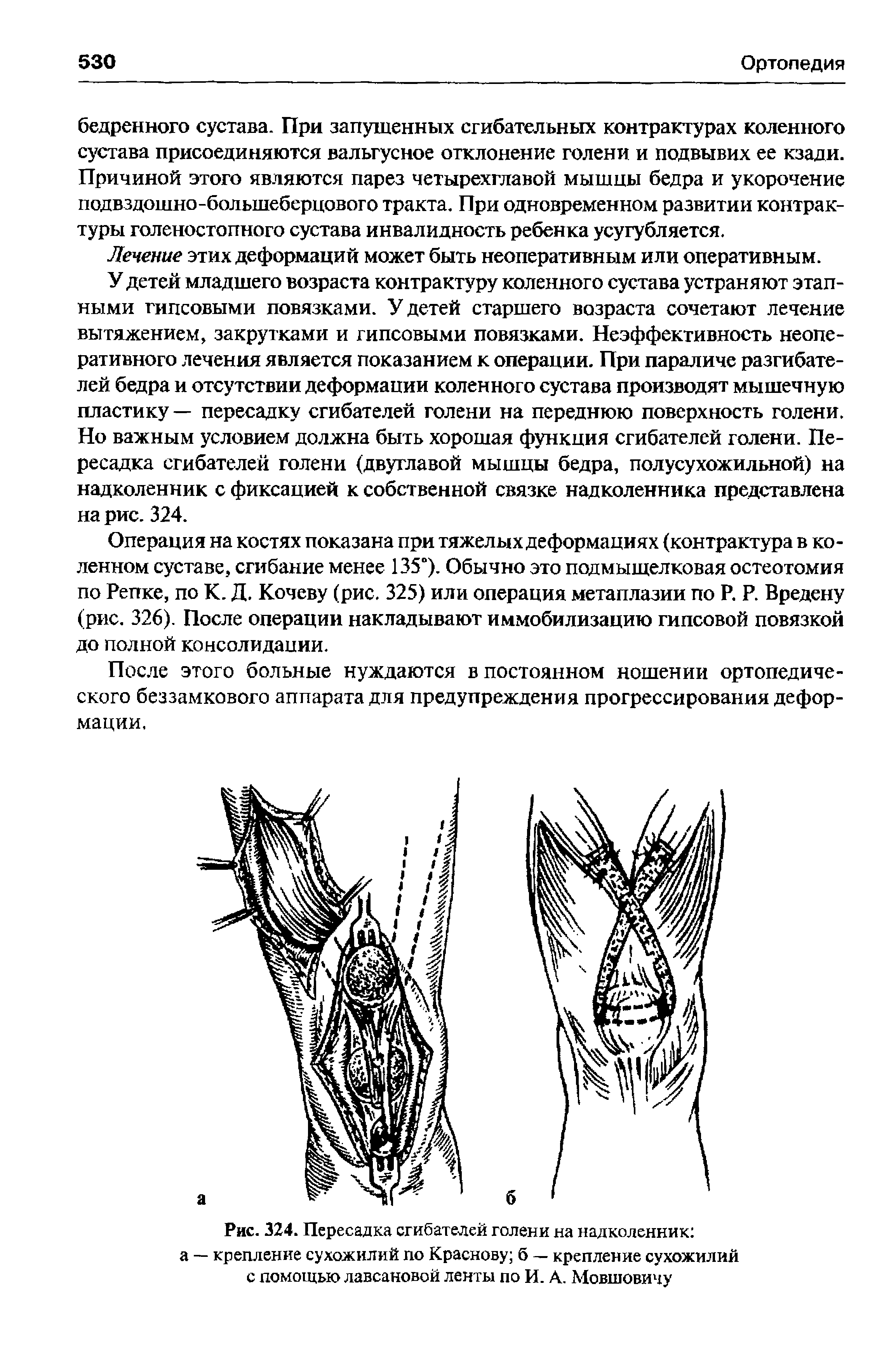 Рис. 324. Пересадка сгибателей голени на надколенник а — крепление сухожилий по Краснову б — крепление сухожилий с помощью лавсановой ленты по И. А. Мовшовичу...