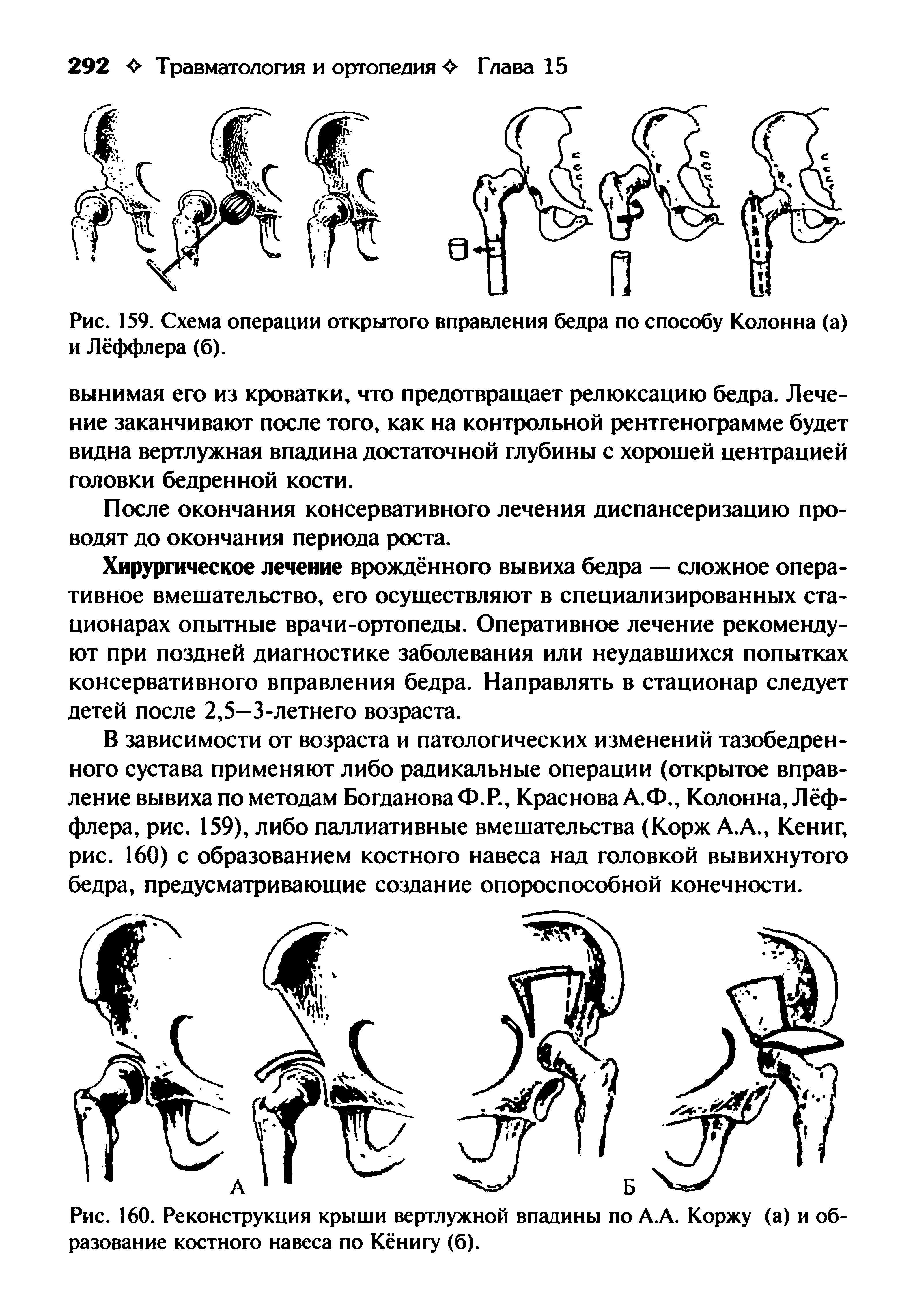 Рис. 160. Реконструкция крыши вертлужной впадины по А.А. Коржу (а) и образование костного навеса по Кёнигу (б).