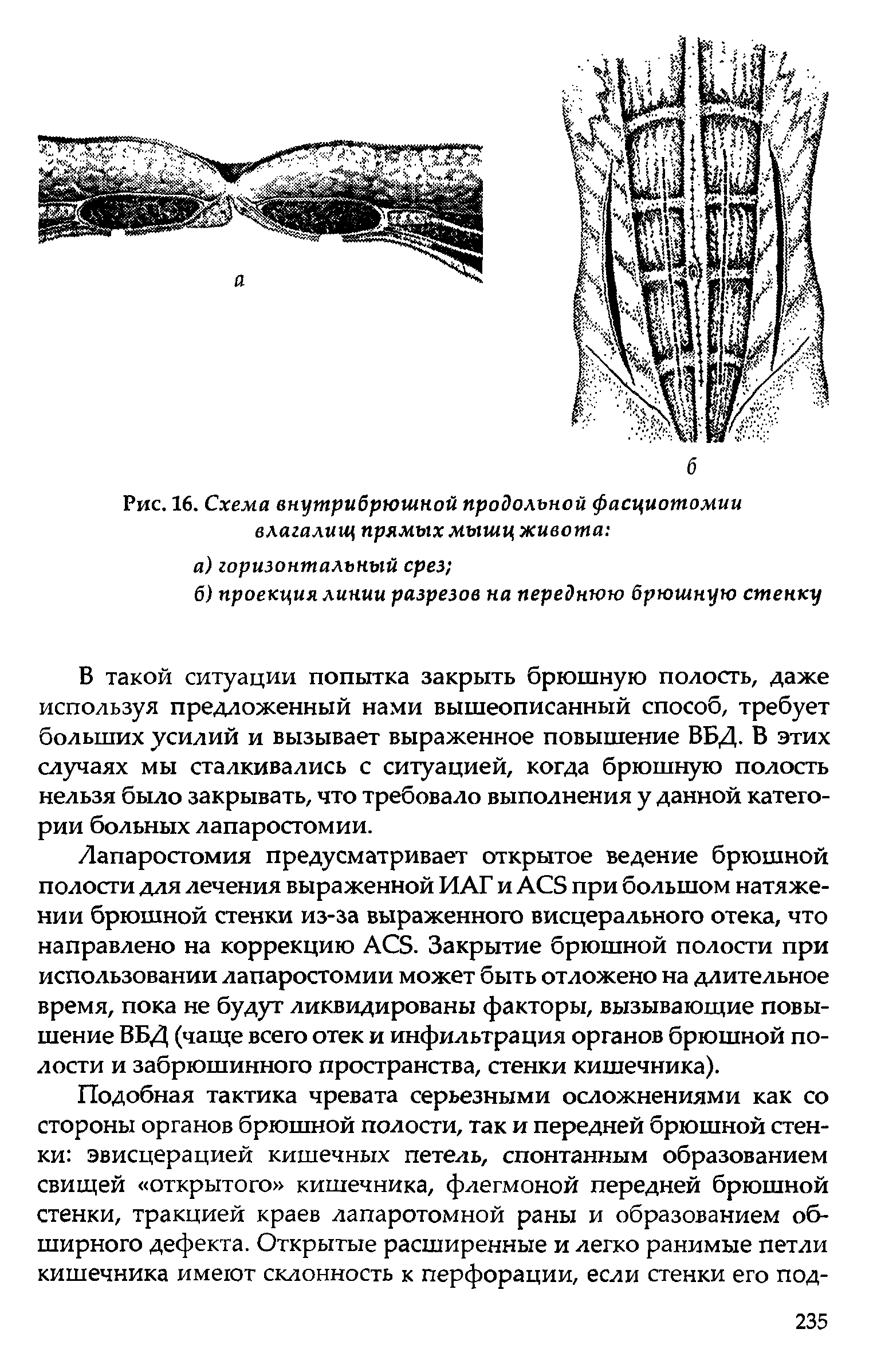 Рис. 16. Схема внутрибрюшной продольной фасциотомии влагалищ прямых мышц живота ...