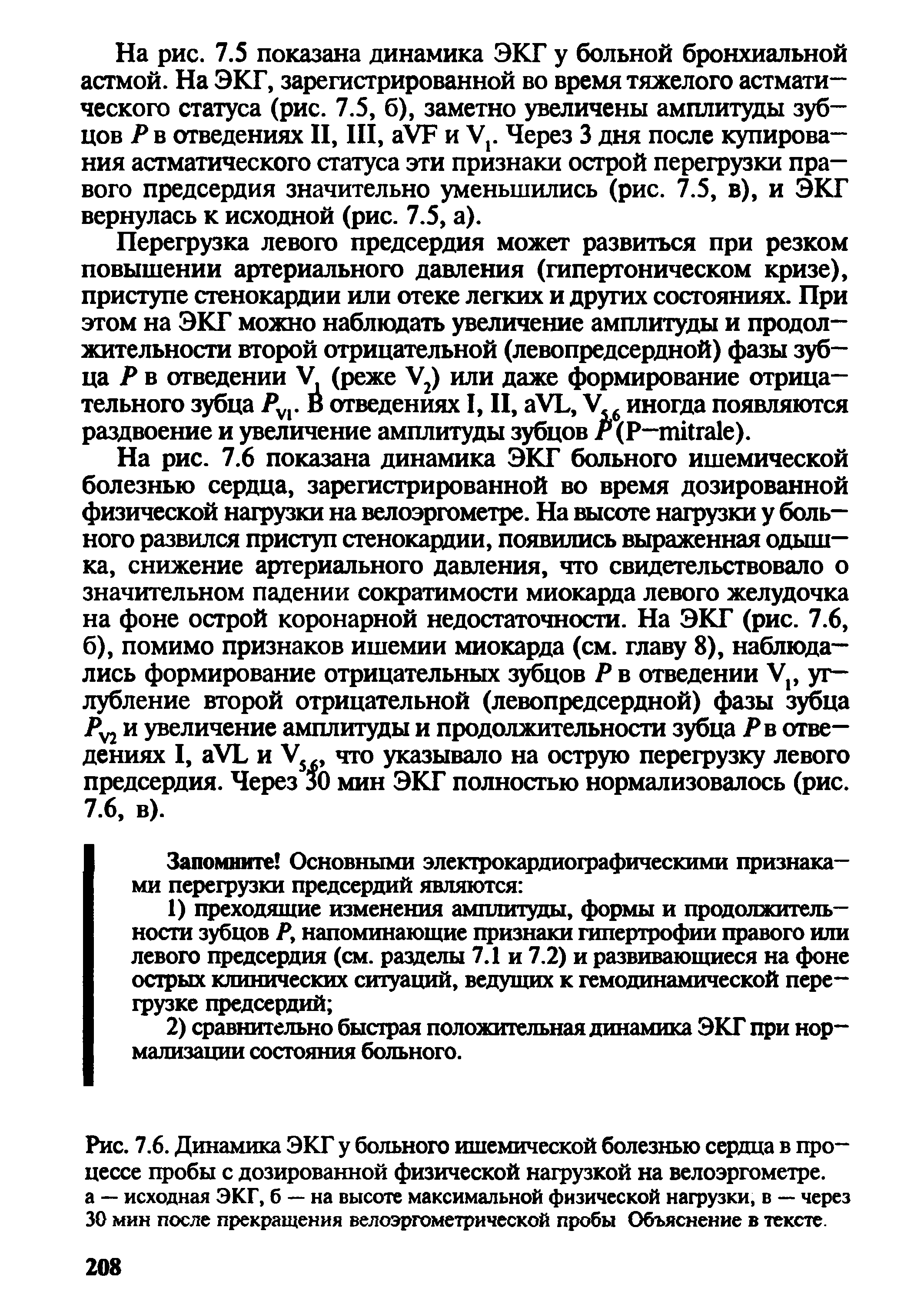 Рис. 7.6. Динамика ЭКГ у больного ишемической болезнью сердца в процессе пробы с дозированной физической нагрузкой на велоэргометре, а — исходная ЭКГ, б — на высоте максимальной физической нагрузки, в — через 30 мин после прекращения велоэргометрической пробы Объяснение в тексте.