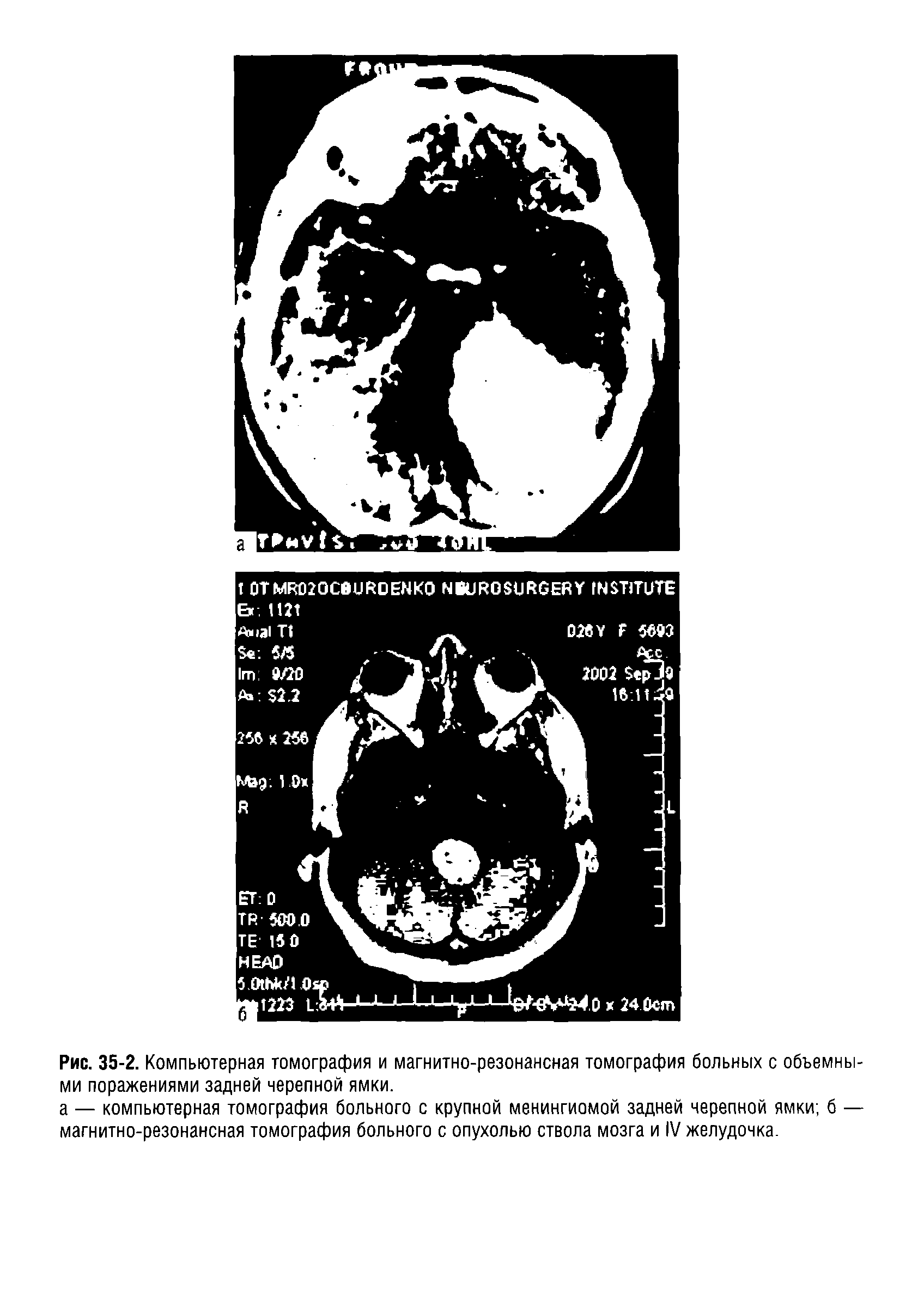 Рис. 35-2. Компьютерная томография и магнитно-резонансная томография больных с объемными поражениями задней черепной ямки.