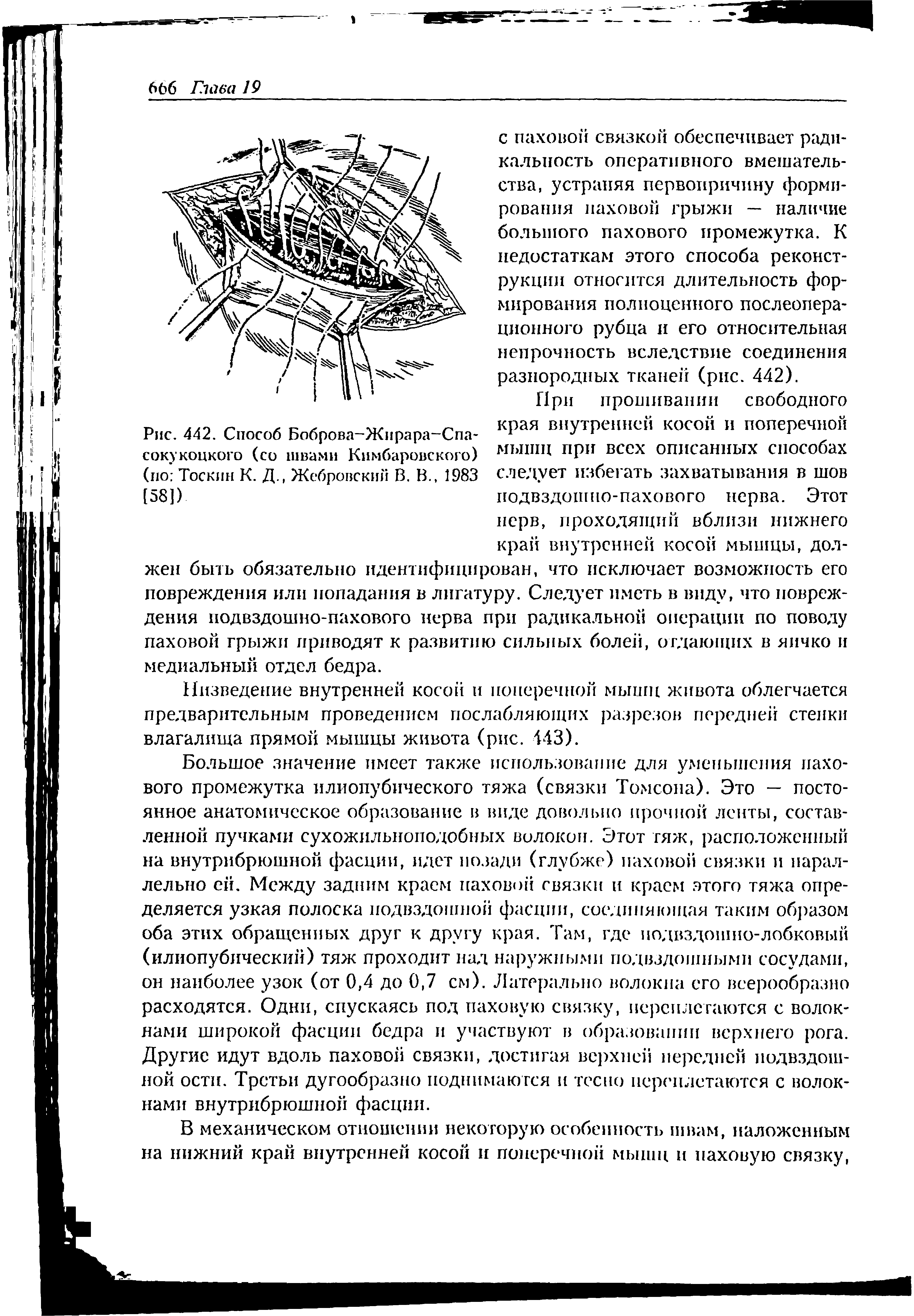 Рис. 442. Способ Боброва-Жирара-Спа-сокукоцкого (со швами Кнмбаровского) (по Тоскин К. Д., Жебровский В. В., 1983 [58])...