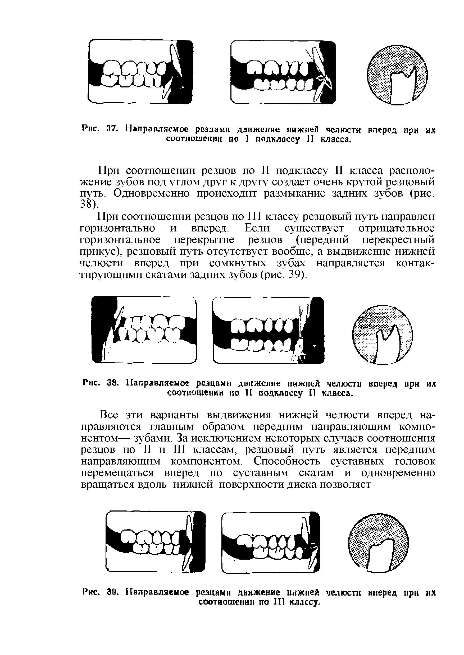 Рис. 39. Направляемое резцами движение нижней челюсти вперед прн их соотношении по III классу.