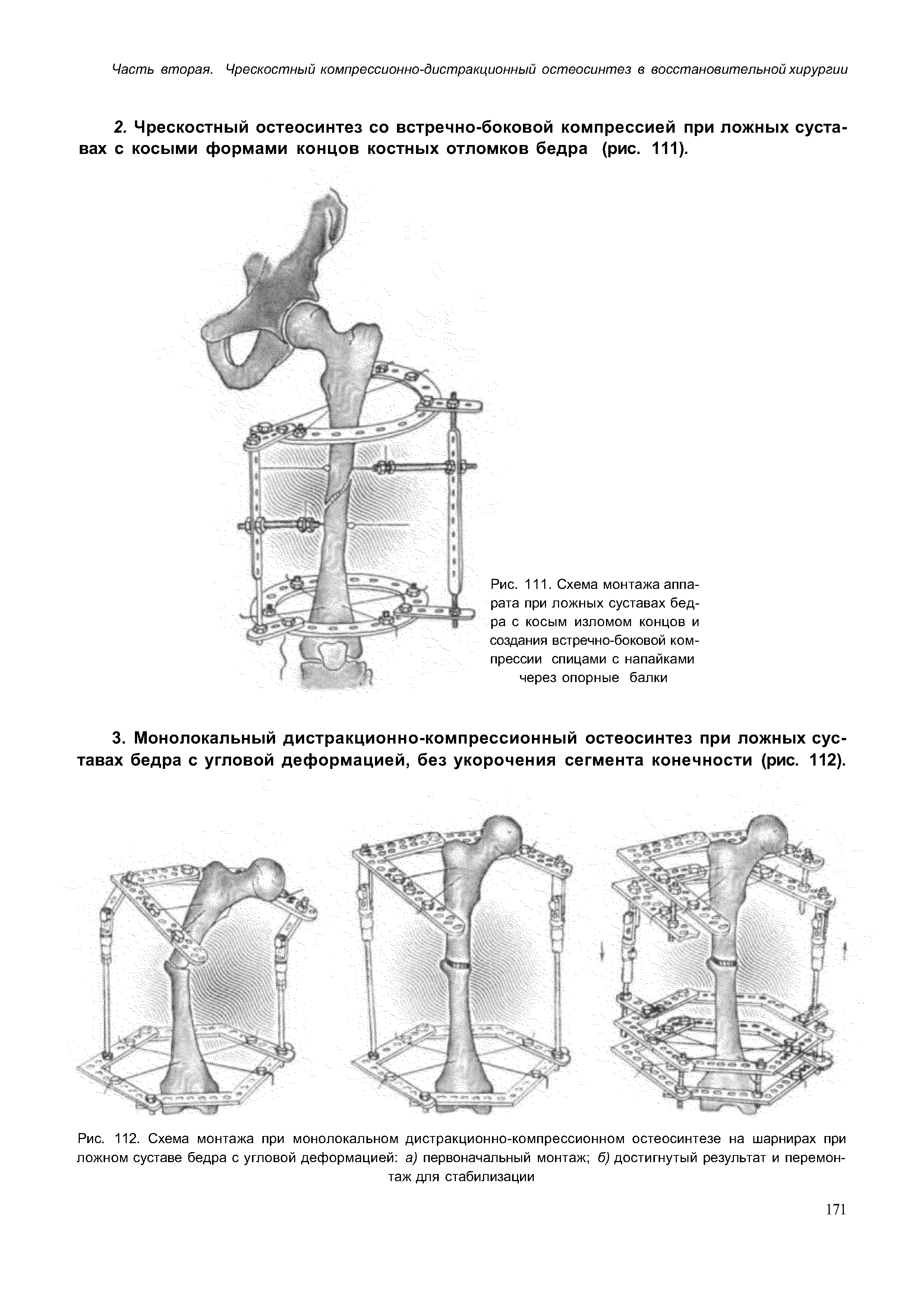 Рис. 112. Схема монтажа при монолокальном дистракционно-компрессионном остеосинтезе на шарнирах при ложном суставе бедра с угловой деформацией а) первоначальный монтаж б) достигнутый результат и перемонтаж для стабилизации...