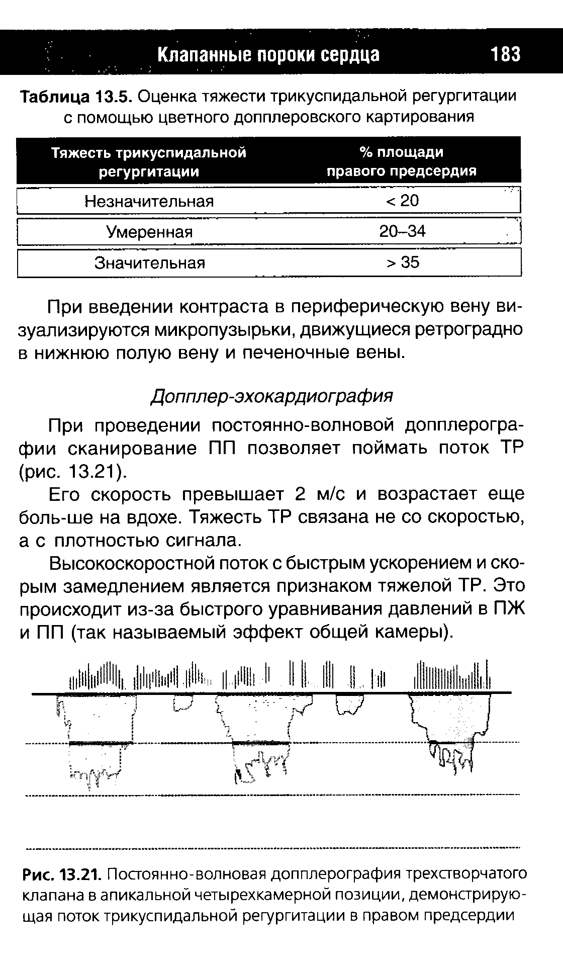 Рис. 13.21. Постоянно-волновая допплерография трехстворчатого клапана в апикальной четырехкамерной позиции, демонстрирующая поток трикуспидальной регургитации в правом предсердии...