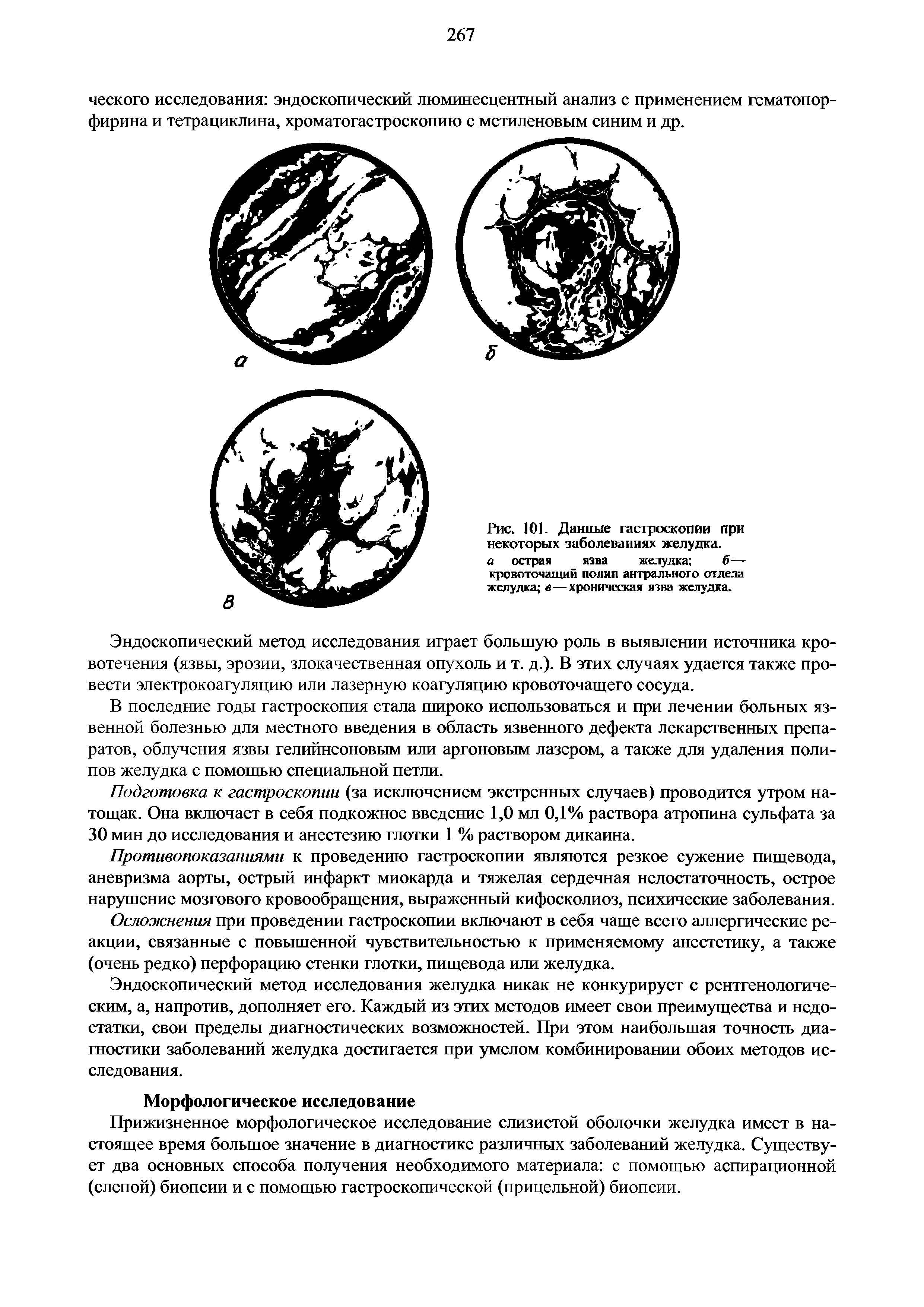 Рис. 101. Данные гастроскопии при некоторых заболеваниях желудка. а острая язва желудка б— кровоточащий полип антрального отдели желудка в—хроническая язва желудка.