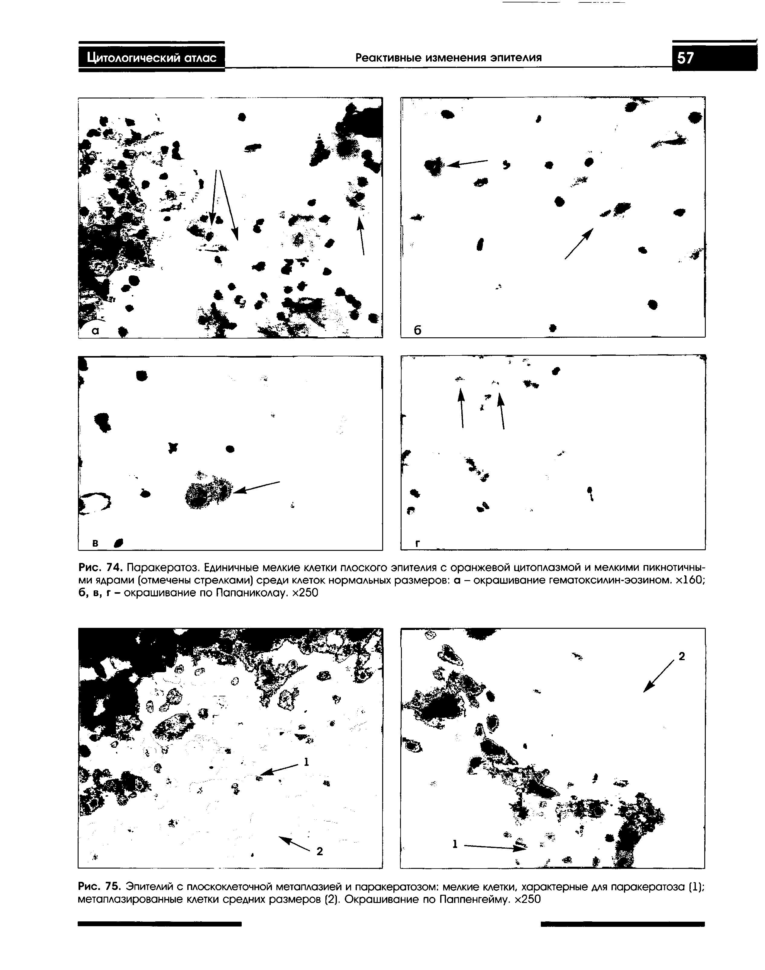 Рис. 74. Паракератоз. Единичные мелкие клетки плоского эпителия с оранжевой цитоплазмой и мелкими пикнотичны-ми ядрами (отмечены стрелками) среди клеток нормальных размеров а - окрашивание гематоксилин-эозином. х160 б, в, г - окрашивание по Папаниколау. х250...