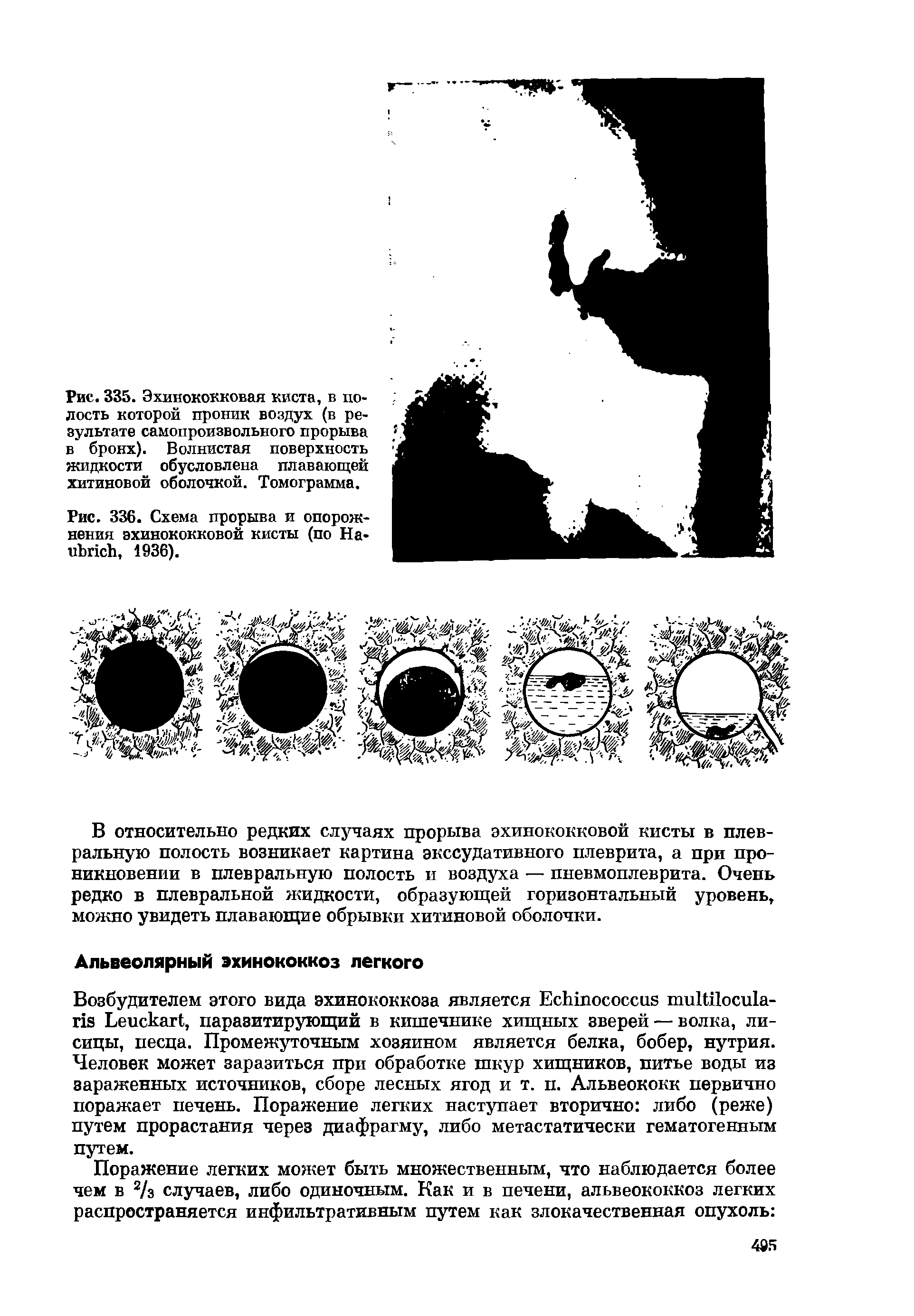 Рис. 336. Схема прорыва и опорожнения эхинококковой кисты (по На-иЪпсЬ, 1936).