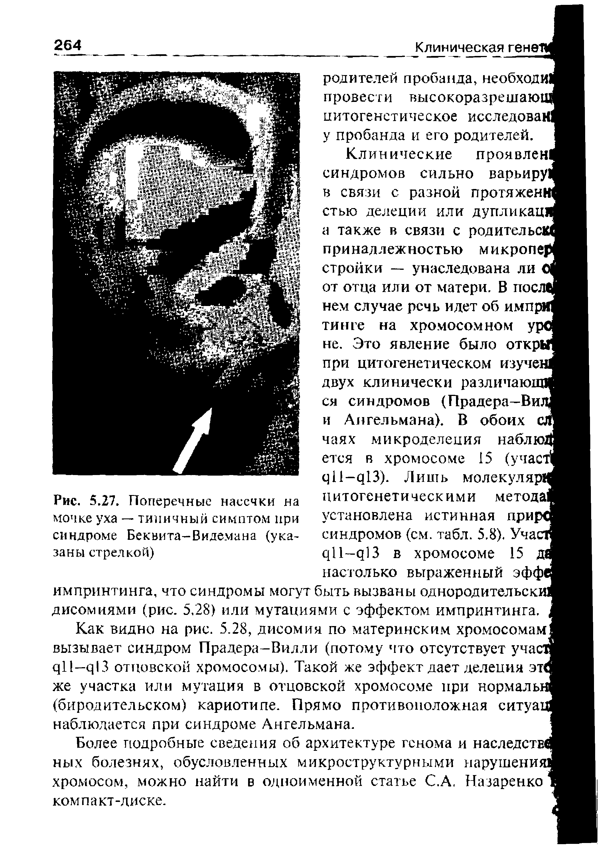 Рис. 5.27. Поперечные насечки на мочке уха — типичный симптом при синдроме Беквита-Видемана (указаны стрелкой)...