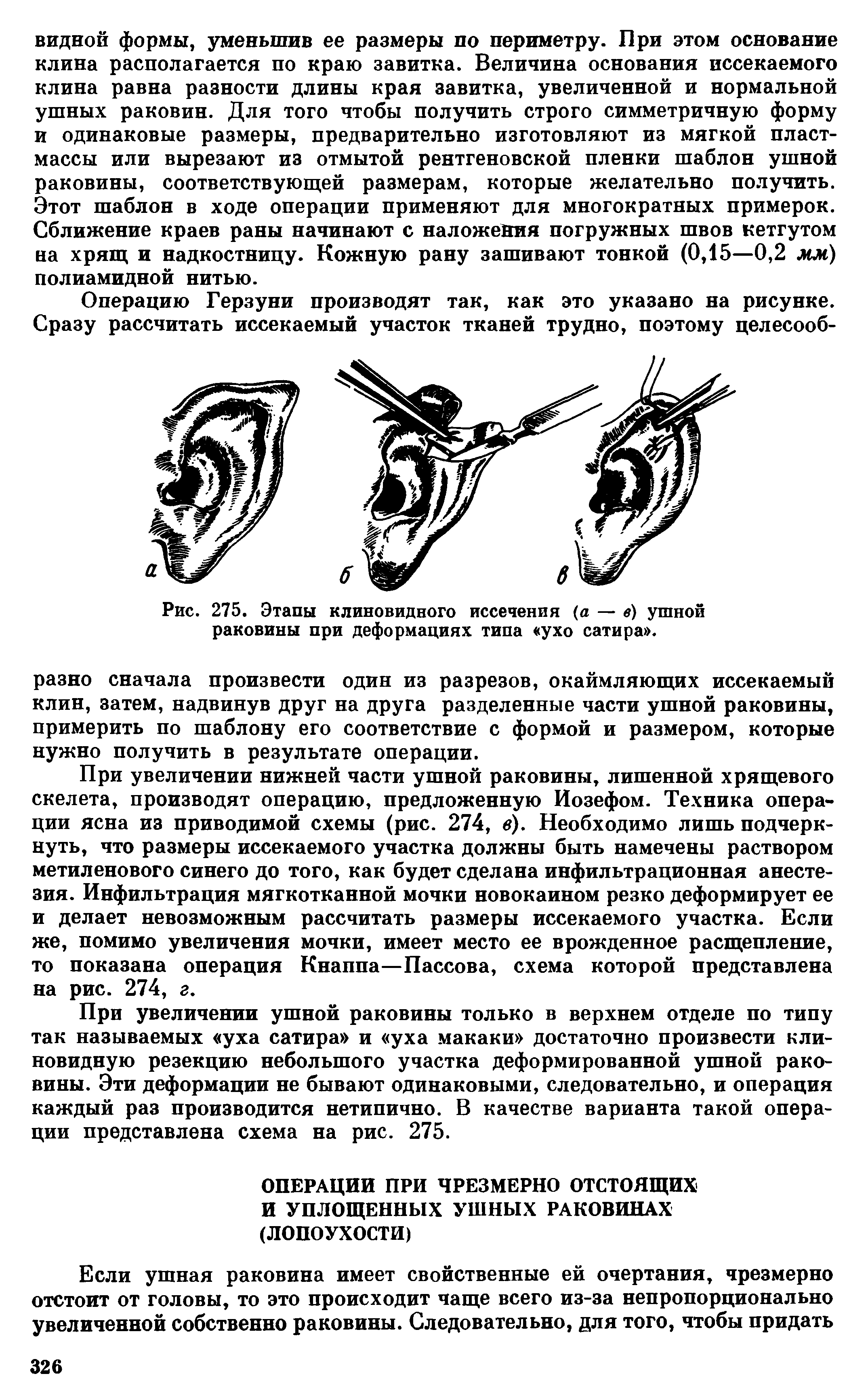 Рис. 275. Этапы клиновидного иссечения (а — в) ушной раковины при деформациях типа ухо сатира .