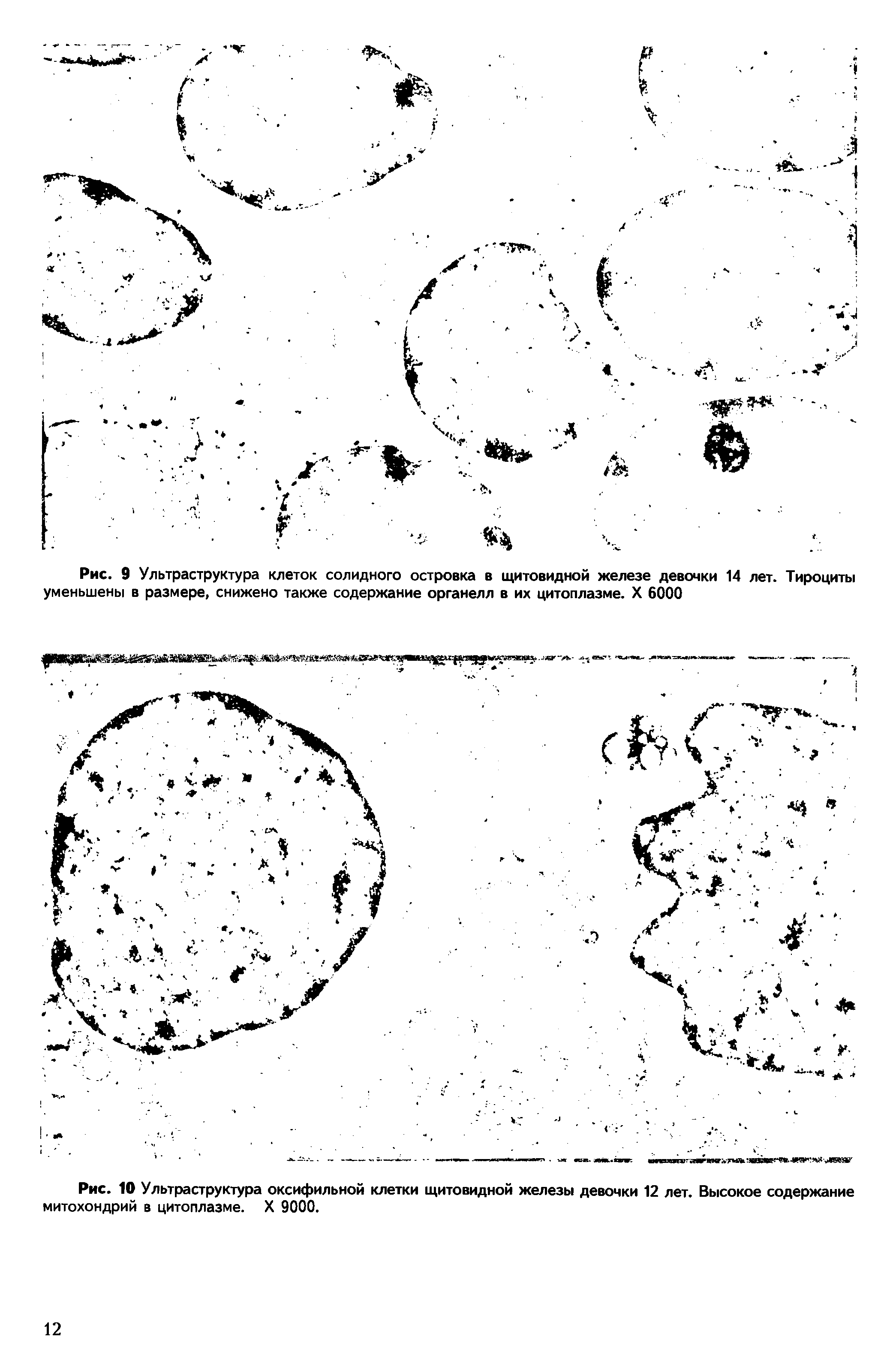 Рис. 10 Ультраструктура оксифильной клетки щитовидной железы девочки 12 лет. Высокое содержание митохондрий в цитоплазме. X 9000.