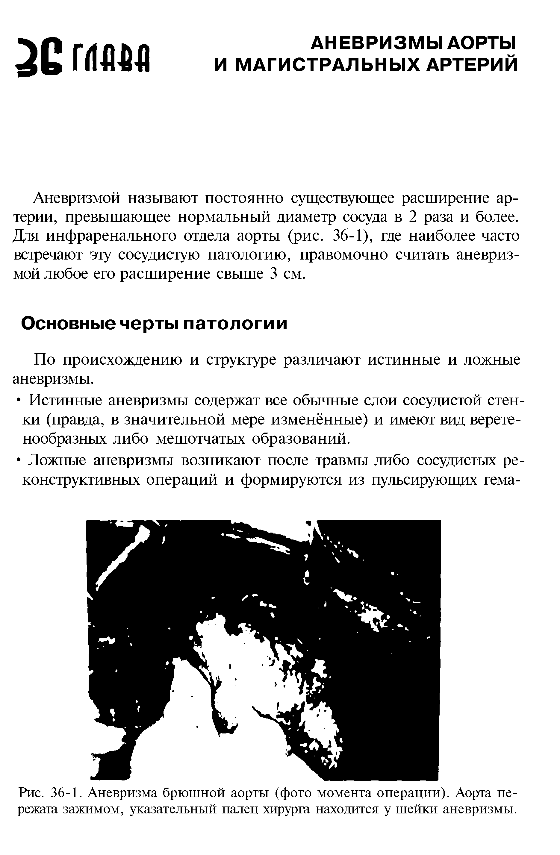 Рис. 36-1. Аневризма брюшной аорты (фото момента операции). Аорта пережата зажимом, указательный палец хирурга находится у шейки аневризмы.