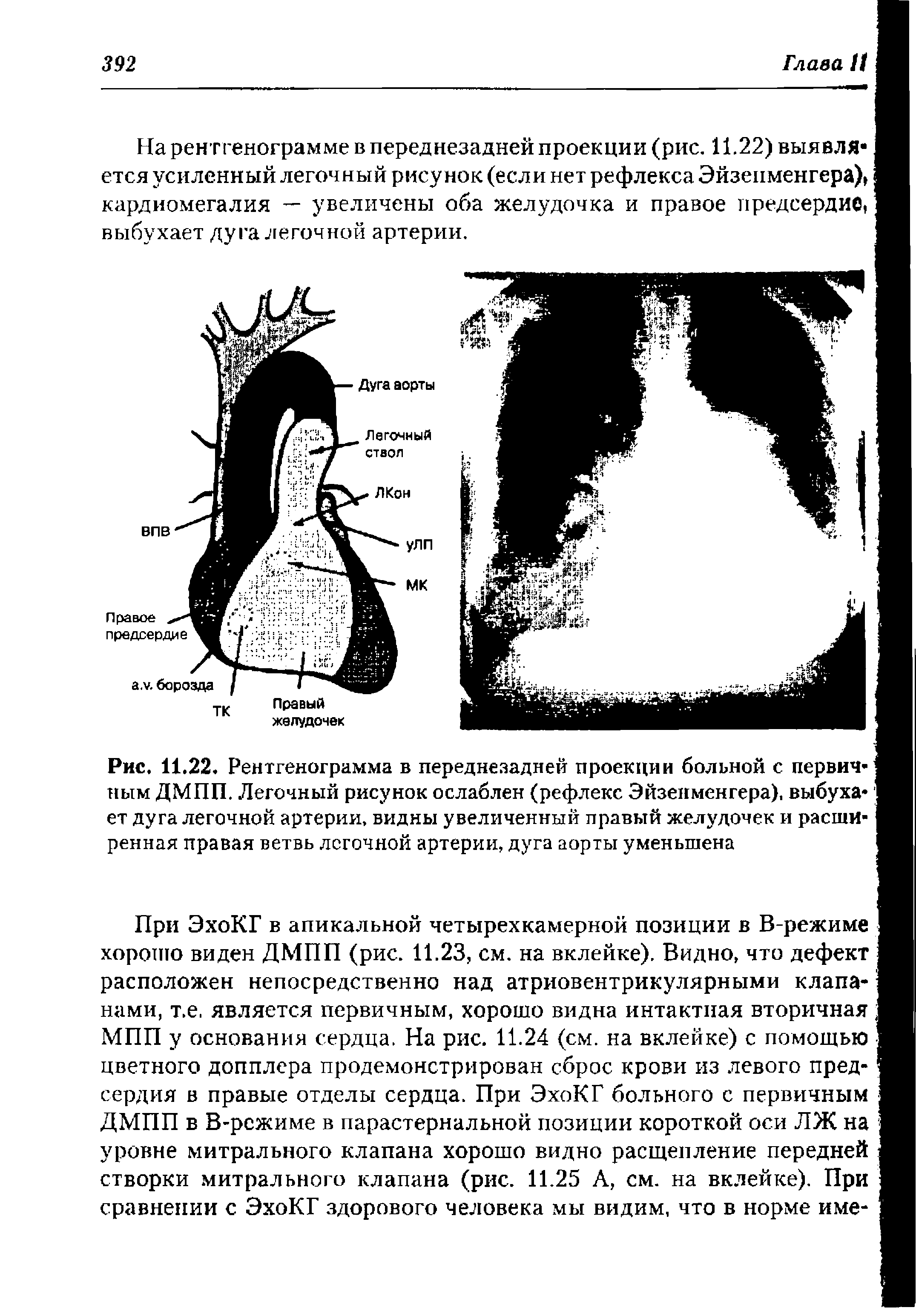 Рис. 11.22. Рентгенограмма в переднезадней проекции больной с первичным ДМПП. Легочный рисунок ослаблен (рефлекс Эйзенменгера), выбухает дуга легочной артерии, видны увеличенный правый желудочек и расширенная правая ветвь легочной артерии, дуга аорты уменьшена...