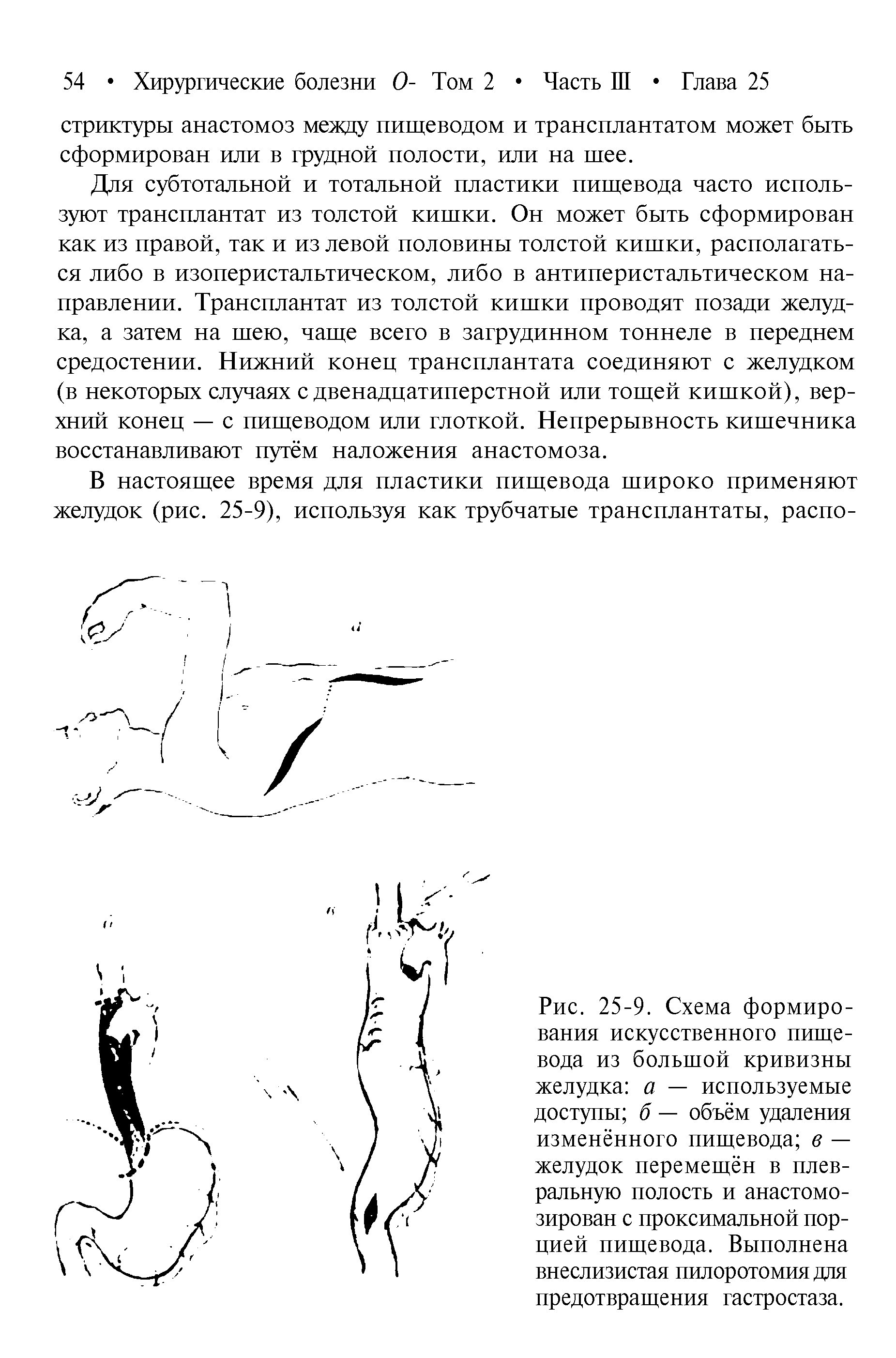Рис. 25-9. Схема формирования искусственного пищевода из большой кривизны желудка а — используемые доступы б — объём удаления изменённого пищевода в — желудок перемещён в плевральную полость и анастомозирован с проксимальной порцией пищевода. Выполнена внеслизистая пилоротомия для предотвращения гастростаза.