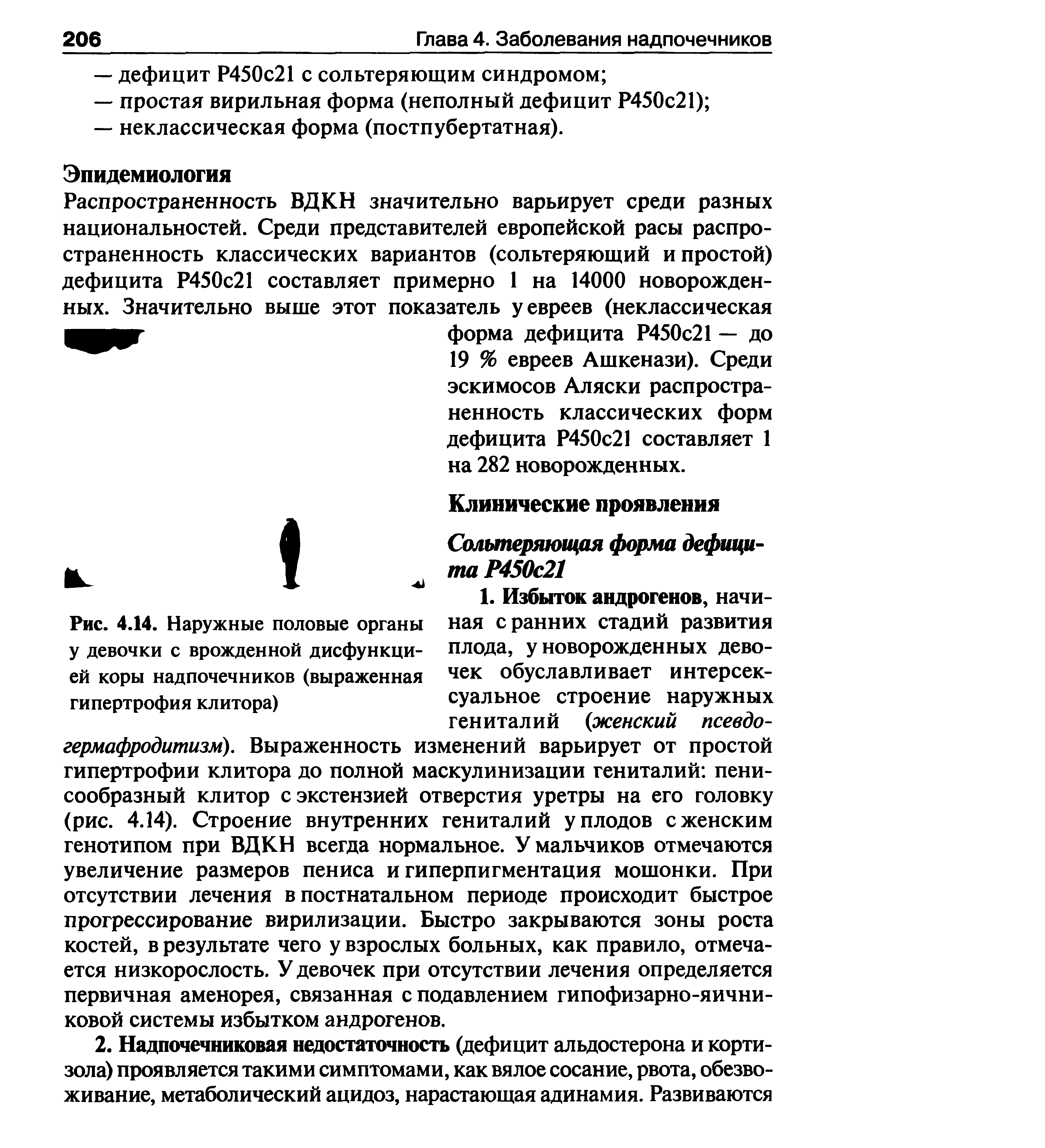 Рис. 4.14. Наружные половые органы у девочки с врожденной дисфункцией коры надпочечников (выраженная гипертрофия клитора)...