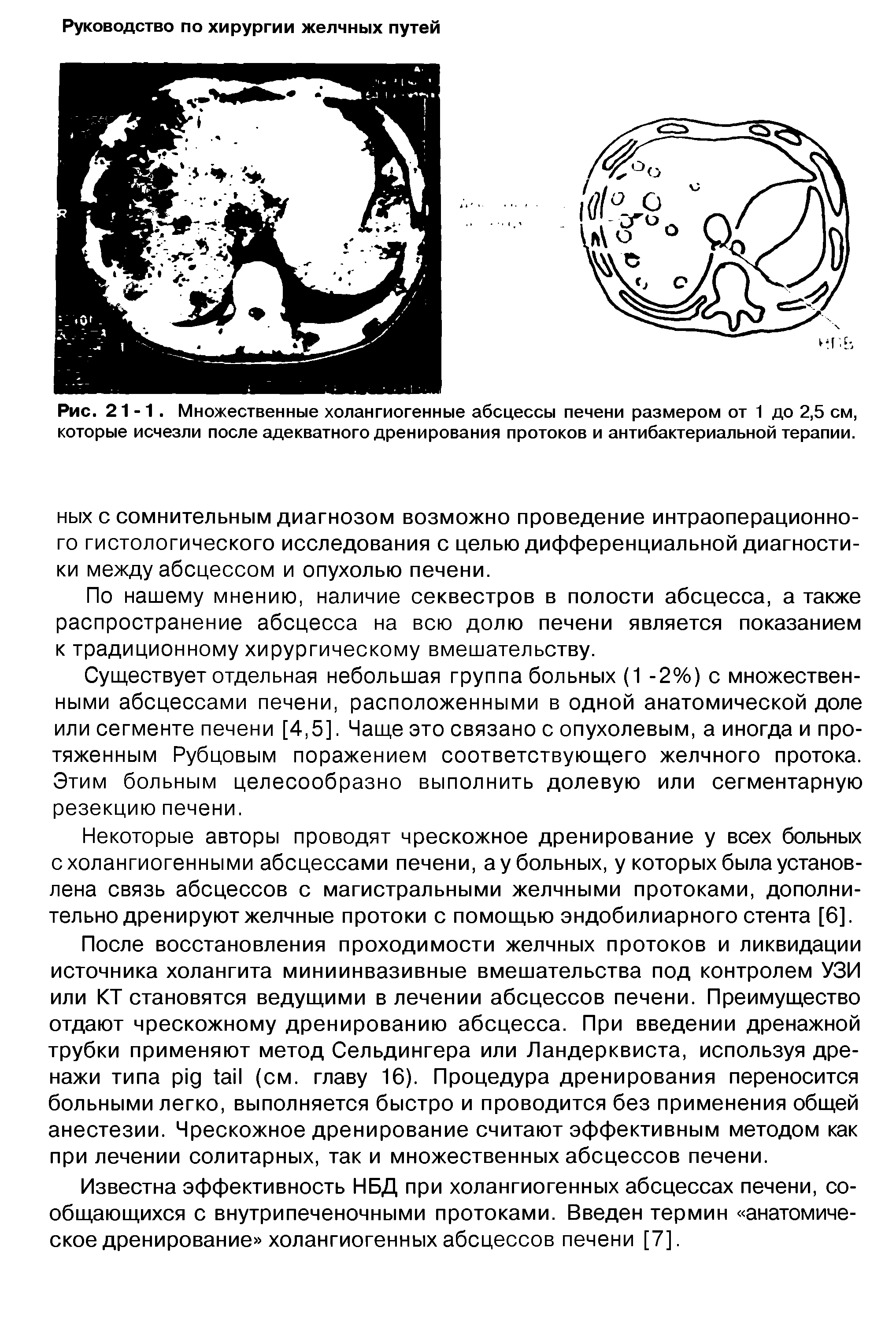 Рис. 21-1. Множественные холангиогенные абсцессы печени размером от 1 до 2,5 см, которые исчезли после адекватного дренирования протоков и антибактериальной терапии.